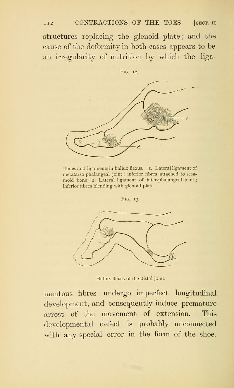 structures replacing the glenoid plate ; and the cause of the deformity in both cases appears to be an irregularity of nutrition by which the liga- FlG. 12. Bones and ligaments in hallux flexus. i. Lateral ligament of metatarso-phalangeal joint; inferior fibres attached to sesa- moid bone; 2. Lateral ligament of inter-phalangeal joint; inferior fibres blending with glenoid plate. Fig. 13. Hallux flexus of the distal joint. mentous fibres undergo imperfect longitudinal development, and consequently induce premature arrest of the movement of extension. This developmental defect is probably unconnected with any special error in the form of the shoe.