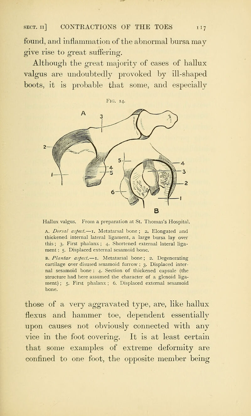 found, and inflammation of the abnormal bursa may give rise to great suffering. Although the great majority of cases of hallux valgus are undoubtedly provoked by ill-shaped boots, it is probable that some, and especially Fig. 14. Hallux valgus. From a preparation at St. Thomas's Hospital. A. Dorsal aspect.—i. Metatarsal bone ; 2. Elongated and thickened internal lateral ligament, a large bursa lay over this; 3. First phalanx ; 4. Shortened external lateral liga- ment ; 5. Displaced external sesamoid bone. B. Plantar aspect.—i. Metatarsal bone; 2. Degenerating cartilage over disused sesamoid furrov/ ; 3. Displaced inter- nal sesamoid bone ; 4. Section of thickened capsule (the structure had here assumed the character of a glenoid liga- ment) ; 5. First phalanx ; 6. Displaced external sesamoid bone. those of a very aggravated type, are, like hallux flexus and hammer toe, dependent essentially upon causes not obviously connected with any vice in the foot covering. It is at least certain that some examples of extreme deformity are confined to one foot, the opposite member being