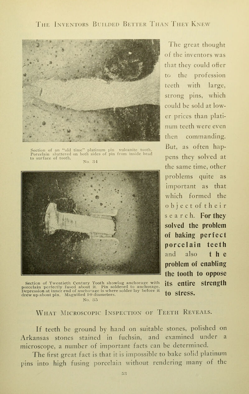 Scclion of an old Uiikj platinum pin vulcanite tooth. Porcelain shattered on both sides of pin from inside head to surface of tooth. No. 34 Till': InvI'LNIoks Biii^dij) I5i:'1'ii:k Tiiax Tiikv Knkvv I'he great thought of the inventors was that they could offer to the profession teeth with large, strong pins, which could be sold at low- er prices than plati- num teeth were even then commanding. But, as often hap- pens they solved at the same time, other problems quite as important as that which formed the object of their search. For they solved the problem of baking perfect porcelain teeth and also the problem of enabling the tooth to oppose Section of Twentieth Century Tooth showing anchorage with Jfg entire Strenffth porcelain perfectly fused about it. Pin soldered to anchorage. * Depression at inner end of anchoraee is where solder lay before it j cirPCC drew up about pin. Magnified 1 0 diameters. 10 slFebS. No. .35 What Microscopic Inspection of Teeth Reveals. If teeth be ground by hand on suitable stones, polished on Arkansas stones stained in fuchsin, and examined under a microscope, a number of important facts can be determined. The first great fact is that it is impossible to bake solid platinum pins into high fusing porcelain without rendering many of the