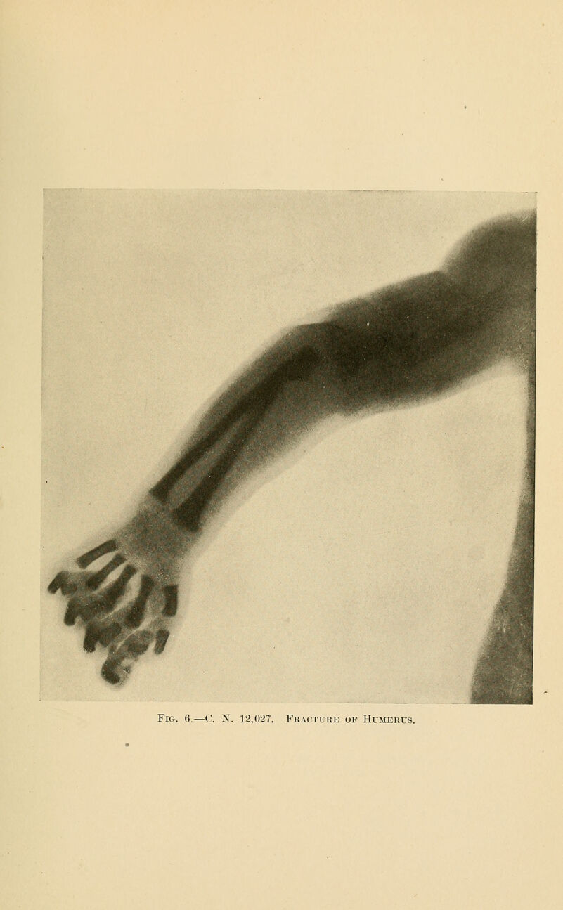 Fig. 6.—C. N. 12,027. Fracture of Humerus.