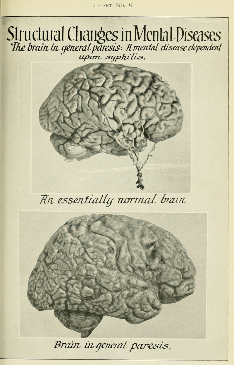 Structural Changes inMenial Diseases The brainingeneralparesis-* Hmodal diseasedependent upon, &tfphel£*s. Tin essentially normal brain Brain in general paresis.