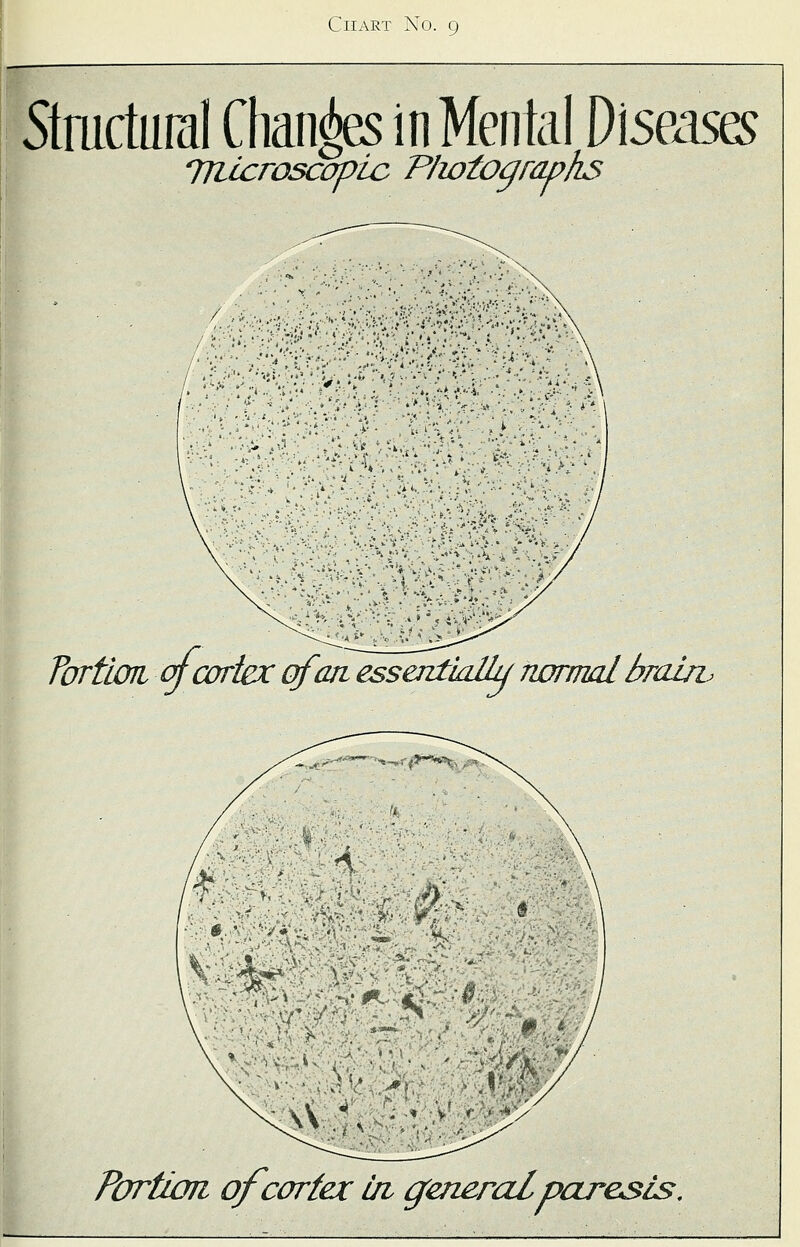 Structural Changes in Mental Diseases microscopic Plwtographs fortiori of cortex of an essentially normal bralw Portion of cortex in generalpar&sis.