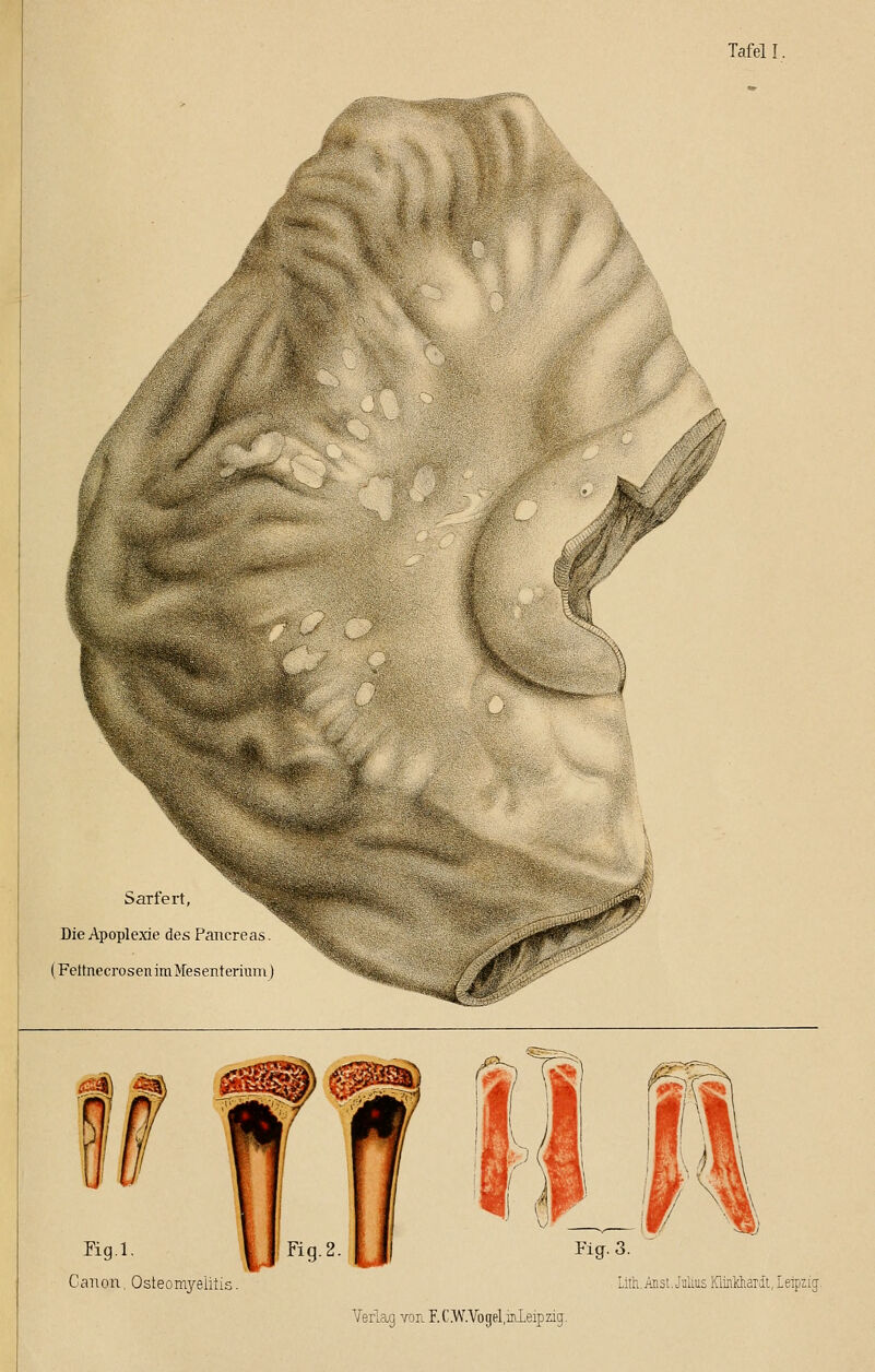 Tafel I. Sarfert, Die Apoplexie des Pancreas. (Fettnecrosen im Mesenterium) Fig.l. Canon, Osteomyelitis Verlag tou F.CM''.Vogel,irLLeipzig.