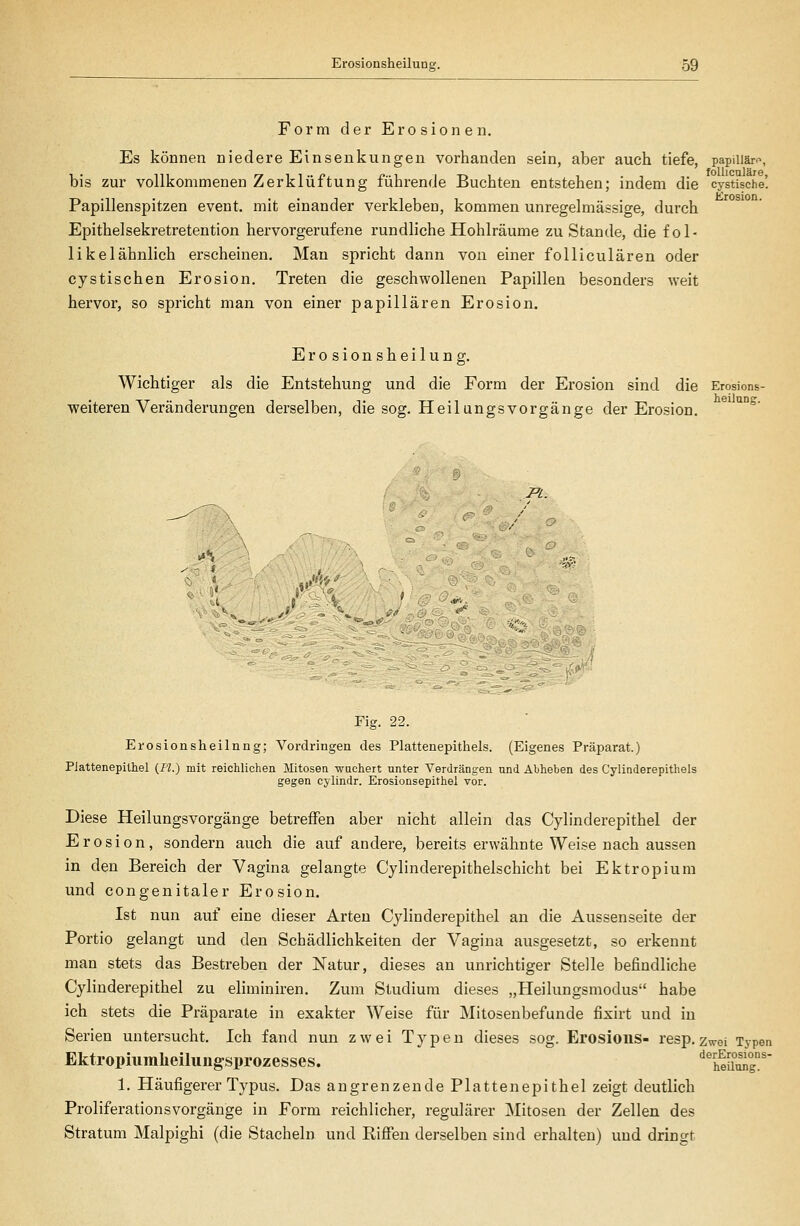 Form der Erosionen. Es können niedere Einsenkungen vorhanden sein, aber auch tiefe, papiUärr-, bis zur vollkommenen Zerklüftung führende Buchten entstehen; indem die cystische! Papillenspitzen event. mit einander verkleben, kommen unregelmässige, durch Epithelsekretretention hervorgerufene rundliche Hohlräume zu Stande, die fol- likelähnlich erscheinen. Man spricht dann von einer foUiculären oder cystischen Erosion. Treten die geschwollenen Papillen besonders weit hervor, so spricht man von einer papillären Erosion. Erosionsheilung. Wichtiger als die Entstehung und die Form der Erosion sind die Erosions- weiteren Veränderungen derselben, die sog. HeilungsVorgänge der Erosion. heilung. s .»'■*?',' M. $^^ '^,^#: Fig. 22. Erosionsheilnng; Vordringen des Plattenepithels. (Eigenes Präparat.) Piattenepithel (I'l.) mit reichlichen Mitosen wuchert unter Verdrängen und Abheben des Cylinderepithels gegen cylindr. Erosionsepithel vor. Diese Heilungsvorgänge betreffen aber nicht allein das Cylinderepithel der Erosion, sondern auch die auf andere, bereits erwähnte Weise nach aussen in den Bereich der Vagina gelangte Cylinderepithelschicht bei Ektropium und congenitaler Erosion. Ist nun auf eine dieser Arten Cylinderepithel an die Aussenseite der Portio gelangt und den Schädlichkeiten der Vagina ausgesetzt, so erkennt man stets das Bestreben der Natur, dieses an unrichtiger Stelle befindliche Cylinderepithel zu eliminiren. Zum Studium dieses „Heilungsmodus habe ich stets die Präparate in exakter Weise für Mitosenbefunde fixirt und in Serien untersucht. Ich fand nun zwei Typen dieses sog. Erosious- resp. zwei Typen Ektropiiimheiluiigsprozesses. '^^SiMg'' 1. Häufigerer Typus. Das angrenzende Platten epithel zeigt deutlich Proliferationsvorgänge in Form reichlicher, regulärer Mitosen der Zellen des Stratum Malpighi (die Stacheln und Rifien derselben sind erhalten) und dringt