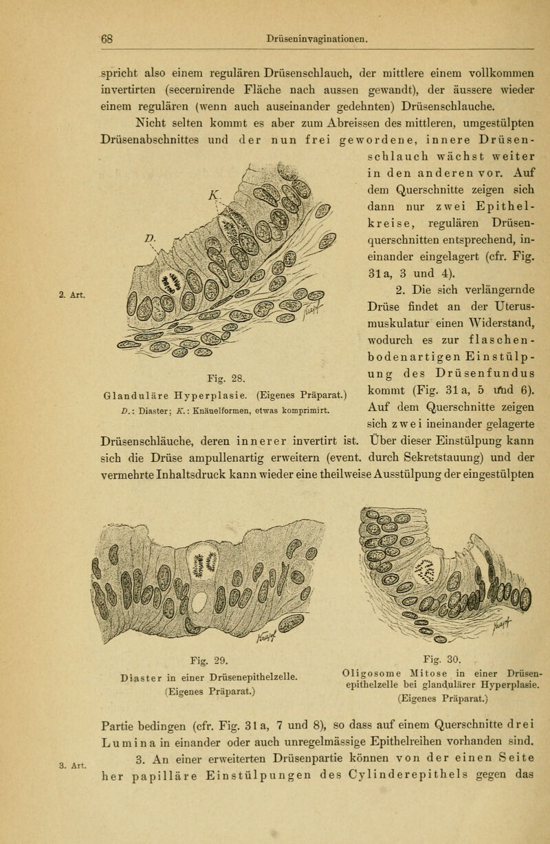 2. Art. spricht also einem regulären Drüsenschlauch, der mittlere einem vollkommen invertirten (secernirende Fläche nach aussen gewandt), der äussere wieder einem regulären (wenn auch auseinander gedehnten) Driisenschlauche. Nicht selten kommt es aber zum Abreissen des mittleren, umgestülpten Drüsenabschnittes und der nun frei gewordene, innere Drüsen- schlauch wächst weiter ^^- in den anderen vor. Auf dem Querschnitte zeigen sich dann nur zwei Epithel- kreise, regulären Drüsen- querschnitten entsprechend, in- einander eingelagert (cfr. Fig. 31a, 3 und 4). 2. Die sich verlängernde Drüse findet an der Uterus- muskulatur einen Widerstand, wodurch es zur flaschen- bodenartigen Einstülp- ung des Drüsenfundus kommt (Fig. 31a, 5 vfnd 6). Auf dem Querschnitte zeigen sich zwei ineinander gelagerte Drüsen schlauche, deren innerer invertirt ist. Über dieser Einstülpung kann sich die Drüse ampullenartig erweitern (event, durch Sekretstauung) und der vermehrte Inhaltsdruck kann wieder eine theilweise Ausstülpung der eingestülpten Fig. 28. Glanduläre Hyperplasie. (Eigenes Präparat.) D.: Diaster; K.: Knänelformen, etwas komprimirt. Fig. 29. Diaster in einer Drüsenepithelzelle. (Eigenes Präparat.) Fig. 30. Oligosome Mitose in einer Drüsen- epithelzelle bei glandulärer Hyperplasie. (Eigenes Präparat.) Partie bedingen (cfr. Fig. 31a, 7 und 8), so dass auf einem Querschnitte drei Lumina in einander oder auch unregelmässige Epithelreihen vorhanden sind. 3. An einer erweiterten Drüseupartie können von der einen Seite her papilläre Einstülpungen des Cy lind erepi thels gegen das