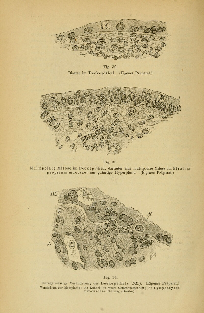 Fig. 32. Diaster im Deckepithel. (Eigenes Präparat.) /i^f %#;:-ÄJkt'® i^,m Fig. 33. Multipolare Mitose im Deckepithel, darunter eine multijjolare Mitose im Stratum proprium mucosae; nur gutartige Hyperplasie. (Eigenes Präi^arat.) DE- ^■'/ -N^v '-^c-» >-.\X rr\' [:J~0-J <7>T/^[ 0h, ■■' ^%s. m ■•'-'■v\ >^\ /^ r Fig. 34. Unregelmässige Veränderung des Deckepithels (DE.). (Eigenes Präparat.) Vorstadinm zur Metaplasie; A': Knäuel; in einem Gefässqnerschnitt; L: Lymphocyt in mitotischer Theilung (Diaster).