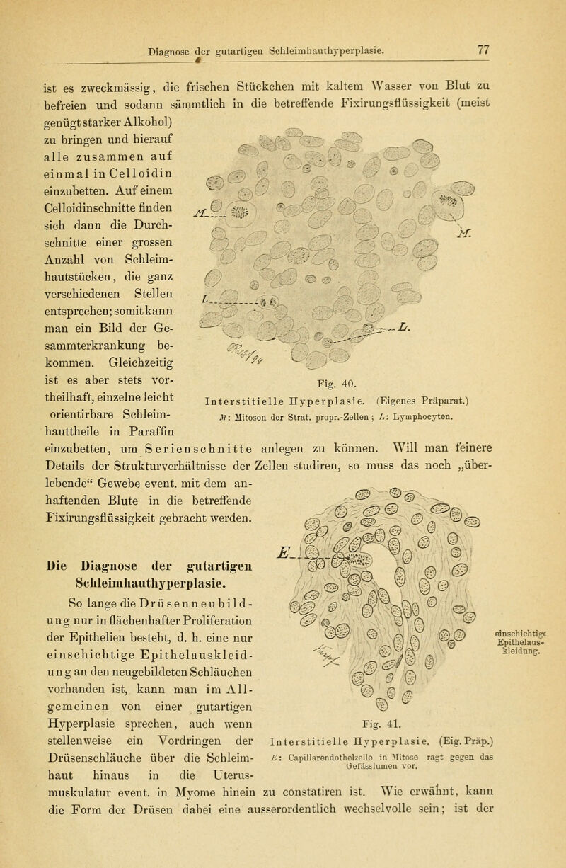 Diagnose der gutartigen Schleimhauthyperplasie. ^_: ist es zweckmässig, die frischen Stückchen mit kaltem Wasser von Blut zu befreien und sodann sämmtlich in die betreffende Fixirungsfiüssigkeit (meist genügt starker Alkohol) zu bringen und hierauf ; ; ^ ^^_ ,;r>v alle zusammen auf . % einmal inCelloidin einzubetten. Auf einem Celloidinschnitte finden sich dann die Durch- schnitte einer grossen Anzahl von Schleim- hautstücken, die ganz verschiedenen Stellen entsprechen; somit kann man ein Bild der Ge- sammterkrankung be- kommen. Gleichzeitig ist es aber stets vor- theilhaft, einzelne leicht orientirbare Schleim- hauttheile in Paraffin einzubetten, um Serienschnitte anlegen zu können. Will man feinere Details der Strukturverhältnisse der Zellen studiren, so muss das noch „über- lebende Gewebe event. mit dem an- -r..L. '^7^ Fig. 40. Interstitielle Hyperplasie. (Eigenes Präparat.) M: Mitosen der Strat. propr.-Zellen ; L: Lymphocyten. haftenden Blute in die betreffende Fixirungsfiüssigkeit gebracht werden. r# m E.. |Ä I ^® -^ Die Diagnose der gutartigen Schleimliautliyperplasie. So lange die Drüsenneubild- ung nur in flächenhafter Proliferation der Epithelien besteht, d. h. eine nur einschichtige Epithelauskleid- ung an den neugebildeten Schläuchen vorhanden ist, kann man im All- gemeinen von einer gutartigen Hyperplasie sprechen, auch weun stellenv/eise ein Vordringen der Drüsenschläuche über die Schleim- haut hinaus in die Uterus- muskulatur event. in Myome hinein zu constatiren ist. Wie erwäliut, kann die Form der Drüsen dabei eine ausserordentlich wechselvolle sein; ist der i) §!> Fig. 41. Interstitielle Hyperplasie. (Eig. Präp.) E: Capillarendothelzelle in Mitose ragt gegen das Gefässlamen vor. einschichtige Epithelaus- kleiduDg.