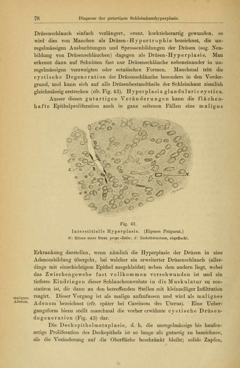 Drüsenschlauch einfach verlängert, event. korkzieherartig gewunden, so wird dies von Manchen als Drüsen-Hypertrophie bezeichnet, die uu- regelmässigen Ausbuchtungen und Sprossenbildungen der Drüsen (sog. Neu- bildung von Drüsenschläuchen) dagegen als Drüsen-Hyperplasie. Man erkennt dann auf Schnitten fast nur Drüseuschläuche nebeneinander in un- regelmässigen verzweigten oder ectatischen Formen. Manchmal tritt die cystische Degeneration der Drüsen schlauche besonders in den Vorder- grund, und kann sich auf alle Drüsenbestandtheile der Schleimhaut ziemlich gleichmässig erstrecken (cfr. Fig. 43). Hy per plasia glandularis cystica. Ausser diesen gutartigen Veränderungen kann die flächen- hafte Epithelproliferatiou auch in ganz seltenen Fällen eine maligne Fig. 42. Interstitielle Hyperplasie. (Eigenes Präparat.) M: Mitose einer Strat. propr.-Zelle; £: Endothelmitose, abgeflacht. malignes Adenom. Erkrankung darstellen, wenn nämlich die Hyperplasie der Drüsen in eine Adenombildung übergeht, bei welcher ein erweiterter Drüsenschlauch (aller- dings mit einschichtigem Epithel ausgekleidet) neben dem andern liegt, wobei das Zwischengewebe fast vollkommen verschwunden ist und ein tieferes Eindringen dieser Schlauchconvolute in die Muskulatur zu con- statiren ist, die dann an den betreffenden Stellen mit kleinzelliger Infiltration reagirt. Dieser Vorgang ist als malign aufzufassen und wird als malignes Adenom bezeichnet (cfr. später bei Carcinom des Uterus). Eine Ueber- gangsform hiezu stellt manchmal die vorher erwähnte cystische Drüsen- degeueration (Fig. 43) dar. Die Deckepithelmetaplasie, d. h. die unregelmässige bis haufen- artige Proliferation des Deckepithels ist so lange als gutartig zu bezeichnen, als die Veränderung auf die Oberfläche beschränkt bleibt; solide Zapfen,