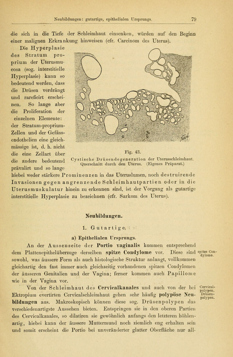 die sich in die Tiefe der Schleimhaut einsenken, würden auf den Beginn einer malignen Erkrankung hinweisen (cfr. Carcinom des Uterus). Die Hyperplasie des Stratum pro- prium der Uterusmu- cosa (sog. interstitielle Hyperplasie) kann so bedeutend werden, dass die Drüsen verdrängt und rareficirt erschei- nen. So lange aber die Proliferation der einzelnen Elemente: der Stratum-proprium- Zellen und der Gefäss- endothelien eine gleich- massige ist, d. h. nicht die eine Zellart über die andere bedeutend prävalirt und so lange hiebei weder stärkere Prominenzen in das Uteruslumen, noch destruirende Invasionen gegen angrenzende Schleimhautparti en oder in die Uterusmuskulatur hinein zu erkennen sind, ist der Vorgang als gutartige interstitielle Hyperplasie zu bezeichnen (cfr. Sarkom des Uterus). Fig. 43. Cystische Drüsendegeneration der Uterusschleimhaut. Querschnitt durch den Uterus. (Eigenes Präparat.) Neubildungen. 1. Gutartige. a) Epithelialen Ursprungs. An der Aussenseite der Portio vaginalis kommen entsprechend dem Plattenepithelüberzuge derselben spitze Condylome vor. Diese sind sowohl, was äussere Form als auch histologische Struktur anlangt, vollkommen gleichartig den fast immer auch gleichzeitig vorhandenen spitzen Condylomen der äusseren Genitalien und der Vagina; ferner kommen auch Papillome wie in der Vagina vor. Von der Schleimhaut des Cervicalkanales und auch von der bei Ektropium evertirten Cervicalschleimhaut gehen sehr häufig polypöse Neu- bildungen aus. Makroskopisch können diese sog. Drüsenpolypen das verschiedenartigste Aussehen bieten. Entspringen sie in den oberen Partien des Cervicalkanales, so dilatiren sie gewöhnlich anfangs den letzteren höhlen- artig, hiebei kann der äussere Muttermund noch ziemlich eng erhalten sein und somit erscheint die Portio bei unveränderter glatter Oberfläche nur all- spitze Con- dylome. Cervical- polypen, Drüsen- polypen.