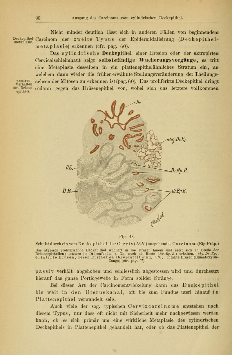 Nicht minder deutlich lässt sich in anderen Fällen von beginnendem Deckepithel-(^{^i-ßiuQjj-^ (j^j. zweite Typus der Epidermidalisirung (Deckepithel- metaplasie) erkennen (cfr. pag. 60). Das cylindrische Deckepithel einer Erosion oder der ektropirten Cervicalschleimhaut zeigt selbstständige Wucheruiigsvorgänge, es tritt eine Metaplasie desselben in ein plattenepithelähnliches Stratum ein, an welchem dann wieder die früher erwähnte Stellungsveränderung der Theilungs- passives achscn der Mitosen zu erkennen ist (pag. 60). Das prolifernte Deckepithel dringt des Drüsen-gQ(jann gegen das Drüsenepithel vor, wobei sich das letztere vollkommen ^ * (f^ ah^.Br.Efi. U.E. DE. Fig. 48. Schnitt durch ein vom Deckepithel der Cervix(i).^.) ausgehendes Ca rein cm. (Eig.Präp.) Das atypisch proliferirende Deckepithel -wachert in die Drüsen hinein und setzt sich an Stelle der Drüsenepithelien; letztere im Drüsenfundus z. Th. noch als Reste {Ur.Ep.li.) erhalten. ahg.Dr.Ep.: dilatirte Drüsen, deren Epithelien abfreplattet sind. i.Ur. : intakte Drüsen (Hämatoxylin- Congo) (cfr. pag. 97). passiv verhält, abgehoben und schliesslich abgestossen wird und durchsetzt hierauf das ganze Portiogewebe in Form solider Stränge. Bei dieser Art der Carcinomentwickelung kann das Deckepithel bis weit in den Uterus kanal, oft bis zum Fundus uteri hinauf i n Flattenepithel verwandelt sein. Auch viele der sog. typischen Cervixcarcinome entstehen nach diesem Typus, nur dass oft nicht mit Sicherheit mehr nachgewiesen werden kann, ob es sich primär um eine wirkliche Metaplasie des cylindrischen Deckepithels in Plattenepithel gehandelt hat, oder ob das Plattenepithel der