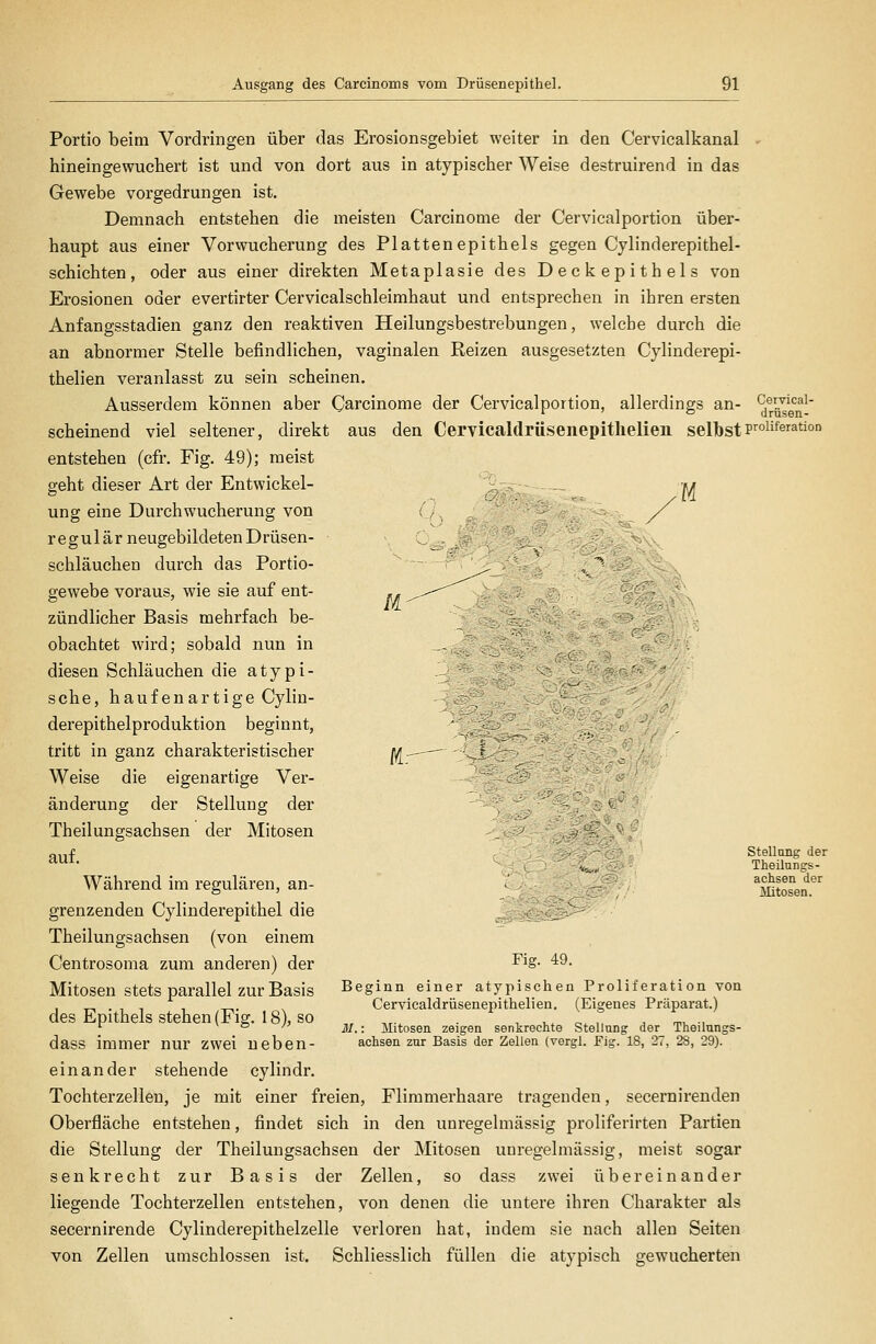 Portio beim Vordringen über das Erosionsgebiet weiter in den Cervicalkanal hineingewuchert ist und von dort aus in atypischer Weise destruirend in das Gewebe vorgedrungen ist. Demnach entstehen die meisten Carcinoma der Cervicalportion über- haupt aus einer Vorwucherung des Plattenepithels gegen Cylinderepithel- schichten, oder aus einer direkten Metaplasie des Deckepithels von Erosionen oder evertirter Cervicalschleimhaut und entsprechen in ihren ersten Anfangsstadien ganz den reaktiven Heilungsbestrebungen, welche durch die an abnormer Stelle befindlichen, vaginalen Reizen ausgesetzten Cylinderepi- thelien veranlasst zu sein scheinen. Ausserdem können aber Carcinome der Cervicalportion, allerdings an- scheinend viel seltener, direkt aus den Cervicaldrüseiiepitlielien selbst entstehen (cfr. Fig. 49); meist M Cervical- driisen- proliferation Ch .ß är geht dieser Art der Entwickel- ung eine Durchwucherung von regulär neugebildeten Drüsen- schläuchen durch das Portio- gewebe voraus, wie sie auf ent- zündlicher Basis mehrfach be- obachtet wird; sobald nun in diesen Schläuchen die atypi- sche, häufenartige Cylin- derepithelproduktion beginnt, tritt in ganz charakteristischer Weise die eigenartige Ver- änderung der Stellung der Theilungsachsen der Mitosen auf. Während im regulären, an- grenzenden Cylinderepithel die Theilungsachsen (von einem Centrosoma zum anderen) der Mitosen stets parallel zur Basis des Epithels stehen (Fig. 18), so dass immer nur zwei neben- einander stehende cylindr. Tochterzellen, je mit einer freien, Flimmerhaare tragenden, secernirenden Oberfläche entstehen, findet sich in den unregelmässig proliferirten Partien die Stellung der Theilungsachsen der Mitosen unregelmässig, meist sogar senkrecht zur Basis der Zellen, so dass zwei übereinander liegende Tochterzellen entstehen, von denen die untere ihren Charakter als secernirende Cylinderepithelzelle verloren hat, indem sie nach allen Seiten von Zellen umschlossen ist. Schliesslich füllen die atypisch gewucherten stellang der Theilungs- achsen der Mitosen. Fig. 49. Beginn einer atypischen Proliferation von Cervicaldrüsenepithelien. (Eigenes Präparat.) 31.: Mitosen zeigen senkrechte Stellung der Theilungs- achsen zur Basis der Zellen (vergl. Fig. 18, 27, 28, 29).