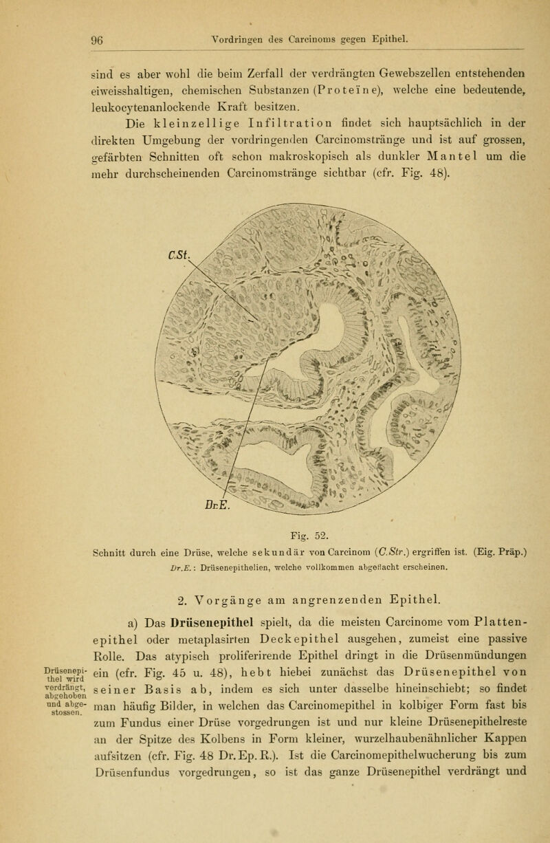 sind es aber wohl die beim Zerfall der verdrängten Gewebszellen entstehenden eiweisshaltigen, chemischen Substanzen (Proteine), welche eine bedeutende, leukocytenanlockende Kraft besitzen. Die kleinzellige Infiltration findet sich hauptsächlich in der direkten Umgebung der vordringenden Carcinomstränge und ist auf grossen, gefärbten Schnitten oft schon makroskopisch als dunkler Mantel um die mehr durchscheinenden Carcinomstränge sichtbar (cfr. Fig. 48). CSi. -1 Kt-* Jt-y i i \ Fig. 52. Schnitt durch eine Drüse, welche sekundär von Carcinom [C.Str.) ergriffen ist. (Eig. Präp.) Jjr.E.: Drüsenepithelien, welche vollkommen abgeHacht erscheinen. 2. Vorgänge am angrenzenden Epithel. a) Das Drüsenepitliel spielt, da die meisten Carcinoma vom Platten- epithel oder metaplasirten Deckepithel ausgehen, zumeist eine passive Rolle. Das atypisch proliferirende Epithel dringt in die Drüsenmündungen Drüsenepi- gjjj ^ßfj._ Y'ig. 45 u. 48), hebt hiebei zunächst das Drüsenepithel von verdrängt, seiner Basis ab, indem es sich unter dasselbe hineinschiebt; so findet abgehoben ' und abge- j^^,^ häufig Bilder, in welchen das Carcinomepithel in kolbiger Form fast bis zum Fundus einer Drüse vorgedrungen ist und nur kleine Drüsenepithelreste an der Spitze des Kolbens in Form kleiner, wurzelhaubenähnlicher Kappen aufsitzen (cfr. Fig. 48 Dr.Ep.R.). Ist die Carcinomepithel Wucherung bis zum Drüsenfundus vorgedrungen, so ist das ganze Drüsenepithel verdrängt und