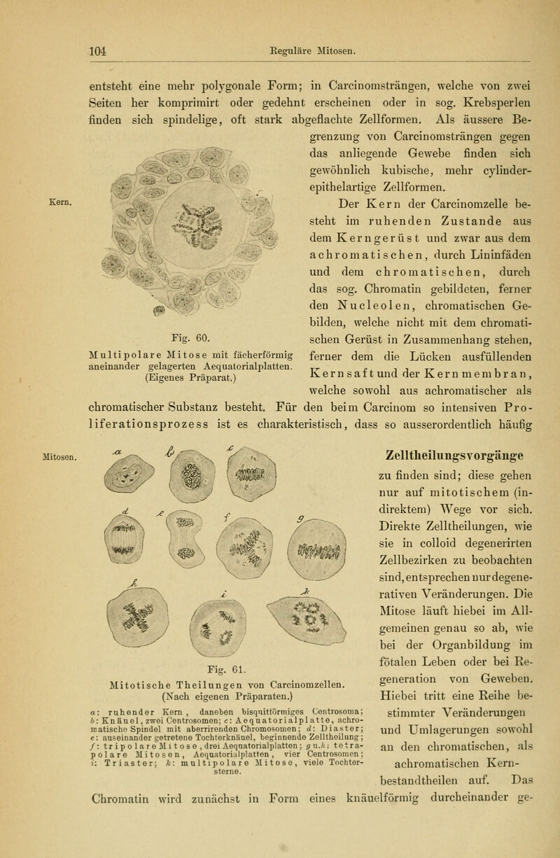 rf^i entsteht eine mehr polygonale Form; in Carcinomsträngen, welche von zwei Seiten her komprimirt oder gedehnt erscheinen oder in sog. Krebsj)erlen finden sich spindelige, oft stark abgeflachte Zellformen. Als äussere Be- grenzung von Carcinomsträngen gegen das anliegende Gewebe finden sich ' ■■ ; gewöhnlich kubische, mehr cylinder- epithelartige Zellformen, ^s™- •<- Der Kern der Carcinomzelle be- steht im ruhenden Zustande aus dem Kerngerüs t und zwar aus dem achromatischen, durch Lininfäden und dem chromatischen, durch das sog. Chromatin gebildeten, ferner den Nucleolen, chromatischen Ge- bilden, welche nicht mit dem chromati- schen Gerüst in Zusammenhang stehen, ferner dem die Lücken ausfüllenden K e r n s a f t und der Kernmembran, welche sowohl aus achromatischer als chromatischer Substanz besteht. Für den beim Carcinom so intensiven Pro- liferationsprozess ist es charakteristisch, dass so ausserordentlich häufig \^ Fig. 60. Multipolare Mitose mit fächerförmig aneinander gelagerten Aequatorialplatten. (Eigenes Präparat.) Mitosen. !>--x ^/ \ /^ '\ s Zelltlieilungsvorgäiige zu finden sind; diese gehen nur auf mitotischem (in- direktem) Wege vor sich. Direkte Zelltheilungen, wie sie in colloid degenerirten Zellbezirken zu beobachten sind, entsprechen nur degene- rativen Veränderungen. Die Mitose läuft hiebei im All- gemeinen genau so ab, wie bei der Organbildung im fötalen Leben oder bei Re- generation von Geweben. Hiebei tritt eine Reihe be- stimmter Veränderungen und Umlagerungen sowohl an den chromatischen, als achromatischen Kern- bestandtheilen auf. Das Chromatin wird zunächst in Form eines knäuelförmig durcheinander ge- Fig. Gl. Mitotische Theilungen von Carcinomzellen. (Nach eigenen Präparaten.) a: ruhender Kern, daneben bisqnittörmiges Centrosoma; h: Knäuel, zwei Centrosomen; c: Aeqnatorialplatte, achjo- niatischo Spindel mit aberrirenden Chromosomen; d: Diaster; e: auseinander getretene Tochterknänel, beginnende Zelltheilung; /: tripolare Mitose,drei Aeqnatorialplatten ; g u.h : tetra- polare Mitosen, Aeqnatorialplatten, vier Centrosomon; i: Triaster; k: multipolare Mitose, viele Tochter- sterne.