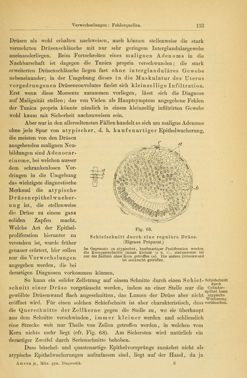 Drüsen als wohl erbalten nachweisen, auch können stellenweise die stark vermehrten Drüsen schlauche mit nur sehr geringem Interglandulargewebe aneinanderliegen. Beim Fortschreiten eines malignen Adenoms in die Nachbarschaft ist dagegen die Tunica propria verschwunden; die stark erweiterten Drüsen schlauche liegen fast ohne interglanduläres Gewebe nebeneinander; in der Umgebung dieses in die Muskulatur des Uterus vorgedrungenen Drüsenconvolutes findet sich kleinzellige Infiltration. Erst wenn diese Momente zusammen vorliegen, lässt sich die Diagnose auf Malignität stellen; das von Vielen als Hauptsymptom angegebene Fehlen der Tunica propria könnte nämlich in einem kleinzellig infiltrirten Gewebe wohl kaum mit Sicherheit nachzuweisen sein. Aber nur in den allerseltensten Fällen handelt es sich um maligne Adenome ohne jede Spur von atypischer, d. h. häuf enartiger Epithelwucherung, die meisten von den Drüsen ausgehenden malignen Neu- bildungen sind Adenocar- cinome, bei welchen ausser dem schrankenlosen Vor- dringen in die Umgebung das wichtigste diagnostische Merkmal die atypische Drüsenepithelwucher- ung ist, die stellenweise die Drüse zu einem ganz soliden Zapfen macht. Welche Art der Epithel- proliferation hierunter zu verstehen ist, wurde früher genauer erörtert, hier sollen nur die Verwechslungen angegeben werden, die bei derartigen Diagnosen vorkommen können. So kann ein solider Zellstrang auf einem Schnitte durch einen Schief- schnitt einer Drüse vorgetäuscht werden, indem an einer Stelle nur die gewölbte Drüsen wand flach angeschnitten, das Lumen der Drüse aber nicht eröffnet wird. Für einen solchen Schiefschnitt ist aber charakteristisch, dass die Querschnitte der Zellkerne gegen die Stelle zu, wo sie überhaupt aus dem Schnitte verschwinden, immer kleiner werden und schliesslich eine Strecke weit nur Theile von Zellen getroffen werden, in welchen vom Kern nichts mehr liegt (cfr. Fig. 68). Am Sichersten wird natürlich ein derartiger Zweifel durch Serienschnitte behoben. Dass büschel- und quastenartige Epithelvorsprünge zunächst nicht als atypische Epithelwucherungen aufzufassen sind, liegt auf der Hand, da ja Amann jr., Mikr. gyn. Diagnostik. 8 Fig. 68. Schief schnitt durch eine reguläre Drüse. (Eigenes Präparat.) Im Gegensatz za atypischer, haufenartiger Proliferation werden die Kernquerschnitte immer kleiner (c u. 6), stellenweise ist nur der Zellleib ohne Kern getroffen (a). Die andere Drüsenwand ist senkrecht getroffen. Schiefschnitt durch Cylinder- epithel kann atypische Wucherung vortäuschen.