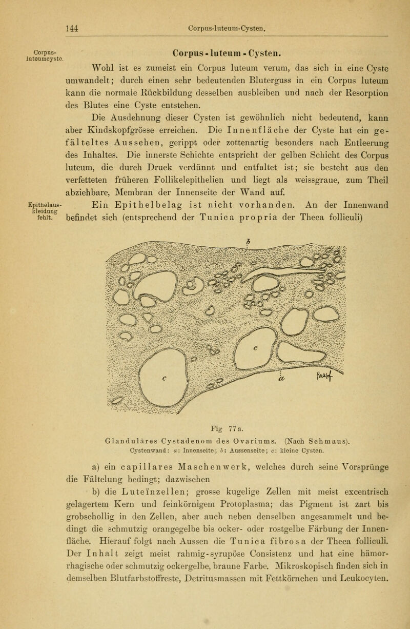 Corpas- Intenmcyste Epithelaus- leidan Corpus - luteum - Cysteu. Wohl ist es zumeist ein Corpus luteum verum, das sich in eine Cyste umwandelt; durch einen sehr bedeutenden Bluterguss in ein Corpus luteum kann die normale Rückbildung desselben ausbleiben und nach der Resorption des Blutes eine Cyste entstehen. Die Ausdehnung dieser Cysten ist gewöhnlich nicht bedeutend, kann aber Kindskopfgrösse erreichen. Die Innenfläche der Cyste hat ein ge- fälteltes Aussehen, gerippt oder zottenartig besonders nach Entleerung des Inhaltes. Die innerste Schichte entspricht der gelben Schicht des Corpus luteum, die durch Druck verdünnt und entfaltet ist; sie besteht aus den verfetteten früheren Follikelepithelien und liegt als weissgraue, zum Theil abziehbare, Membran der Innenseite der Wand auf. Ein Epithelbelag ist nicht vorhanden. An der Innenwand fehlt. befindet sich (entsprechend der Tu nie a propria der Theca folliculi) Fig 77 a. Glanduläres Cystadenoru des Ovariums. (Nach Schmaus). Cystenwand : a: Innenseite ; b: Aussenseite; c: kleine Cysten. a) ein capillares Maschenwerk, welches durch seine Vorsprünge die Fältelung bedingt; dazwischen b) die Luteinzellen; grosse kugelige Zellen mit meist excentrisch gelagertem Kern und feinkörnigem Protoplasma; das Pigment ist zart bis grobschollig in den Zellen, aber auch neben denselben angesammelt und be- dingt die schmutzig orangegelbe bis ocker- oder rostgelbe Färbung der Innen- fläche. Hierauf folgt nach Aussen die Tunica fibrosa der Theca folliculi. Der Inhalt zeigt meist rahmig-syrupöse Consistenz und hat eine hämor- rhagische oder schmutzig ockergelbe, braune Farbe. Mikroskopisch finden sich in demselben Blutfarbstoffreste, Detritusmassen mit Fettkörnchen und Leukocyten.