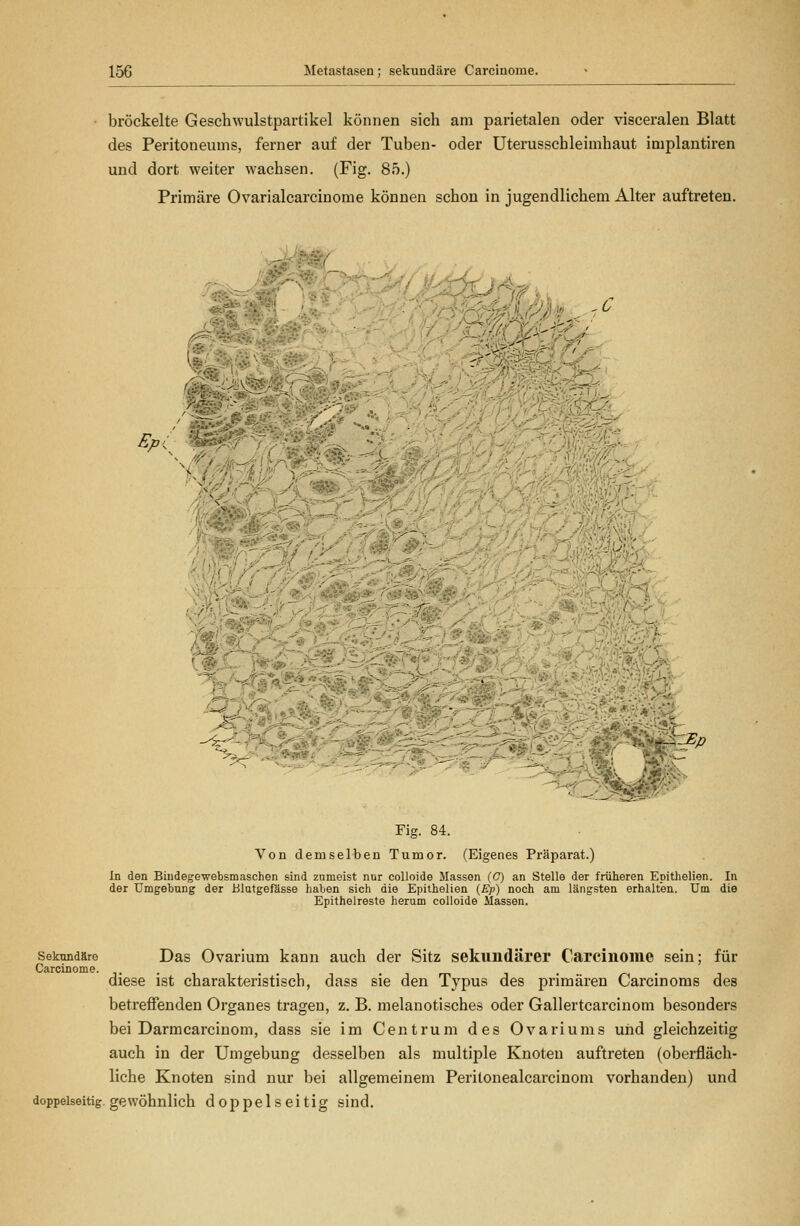 bröckelte Geschwulstpartikel können sich am parietalen oder visceralen Blatt des Peritoneums, ferner auf der Tuben- oder Uterusscbleimhaut implantiren und dort weiter wachsen. (Fig. 85.) Primäre Ovarialcarcinome können schon in jugendlichem Alter auftreten. ,^ Fig. 84. Von demselben Tumor. (Eigenes Präparat.) In den Biudegewebsmaschen sind zumeist nur coUoide Massen (C) an Stelle der früheren Epithelien. In der Umgebung der Blutgefässe haben sich die Epithelien (£» noch am längsten erhalten. Um die Epithelreste herum colloide Massen. Sekundäre Das Ovarium kann auch der Sitz sekundärer Carcinome sein; für Carcinome. ,. • i i • • • i i • /-< • diese ist charakteristisch, dass sie den Typus des primären Carcinoms des betreifenden Organes tragen, z. B. melanotisches oder Gallertcarcinom besonders bei Darmcarcinom, dass sie im Centrum des Ovariums und gleichzeitig auch in der Umgebung desselben als multiple Knoten auftreten (oberfläch- liche Knoten sind nur bei allgemeinem Peritonealcarcinom vorhanden) und doppelseitig, gewöhnlich doppelseitig sind.