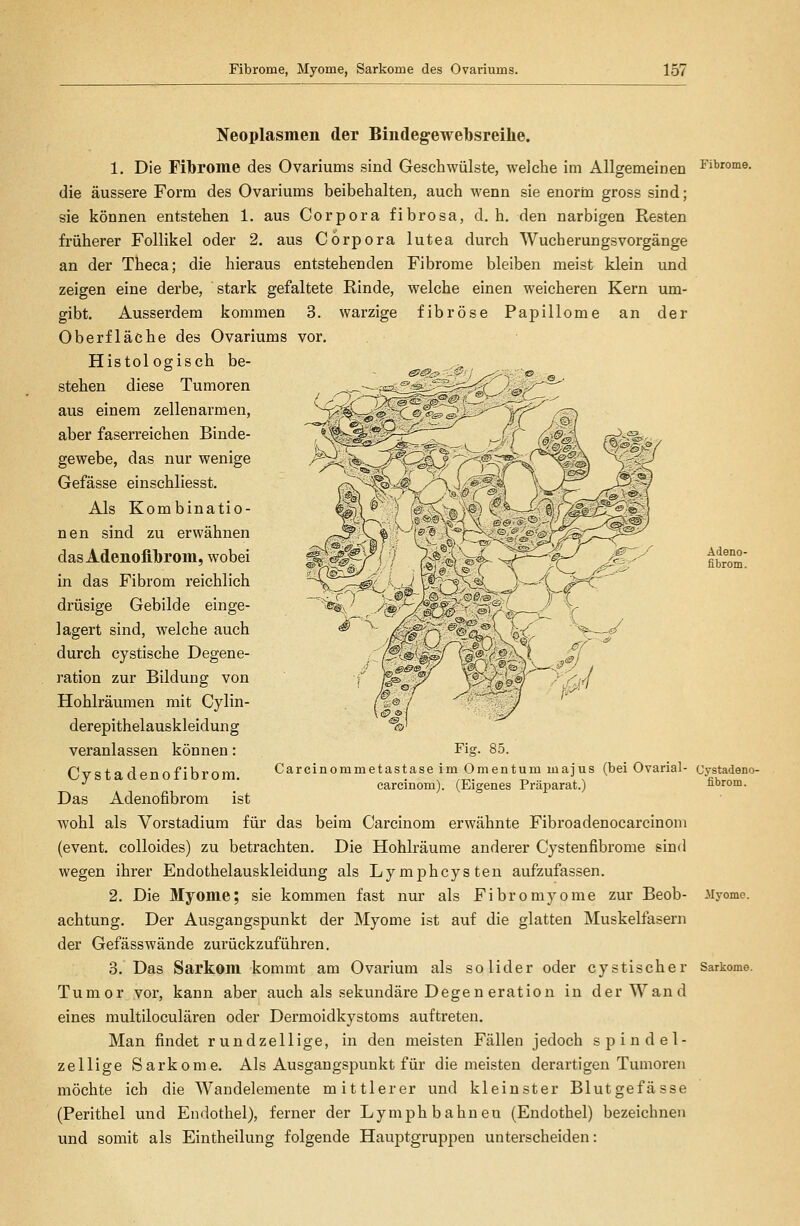 Neoplasmen der Bindeg-ewebsreihe. 1. Die Fibrome des Ovariums sind Geschwülste, welche im AllgemeiDen Fibrome, die äussere Form des Ovariums beibehalten, auch wenn sie enorin gross sind; sie können entstehen 1. aus Corpora fibrosa, d. h. den narbigen Resten früherer Follikel oder 2. aus Corpora lutea durch Wucherungsvorgänge an der Theca; die hieraus entstehenden Fibrome bleiben meist klein und zeigen eine derbe, stark gefaltete Rinde, welche einen weicheren Kern um- gibt. Ausserdem kommen 3. warzige fibröse Papillome an der Oberfläche des Ovariums vor. Histologisch be- ^ stehen diese Tumoren aus einem zellenarmen, aber faserreichen Binde- gewebe, das nur wenige Gefässe einschliesst. Als Kombinatio- nen sind zu erwähnen das Adenofibrom, wobei in das Fibrom reichlich drüsige Gebilde einge- lagert sind, welche auch durch cystische Degene- ration zur Bildung von Hohlräumen mit Cylin- derepithelauskleidung Adeno- fibrom. Fig. 85. Carcinommetastase im Omentum majus (bei Ovaria!- Cystadeno- carcinom). (Eigenes Präparat.) fibrom. veranlassen können: Cystadeno fibrom. Das Adenofibrom ist wohl als Vorstadium für das beim Carcinom erwähnte Fibroadenocarcinom (event. colloides) zu betrachten. Die Hohlräume anderer Cystenfibrome sind wegen ihrer Endothelauskleidung als Lymphcysten aufzufassen. 2. Die Myome; sie kommen fast nur als Fibromyome zur Beob- iiyomo. achtung. Der Ausgangspunkt der Myome ist auf die glatten Muskelfasern der Gefässwände zurückzuführen. 3. Das Sarkom kommt am Ovarium als solider oder cystischer Sarkome. Tumor .vor, kann aber auch als sekundäre Degen eration in der Wand eines multiloculären oder Dermoidkystoms auftreten. Man findet rundzellige, in den meisten Fällen jedoch spindel- zellige Sarkome. Als Ausgangspunkt für die meisten derartigen Tumoren möchte ich die Wandelemente mittlerer und kleinster Blutgefässe (Perithel und Endothel), ferner der Lymph bahnen (Endothel) bezeichnen und somit als Eintheilung folgende Hauptgruppen unterscheiden: