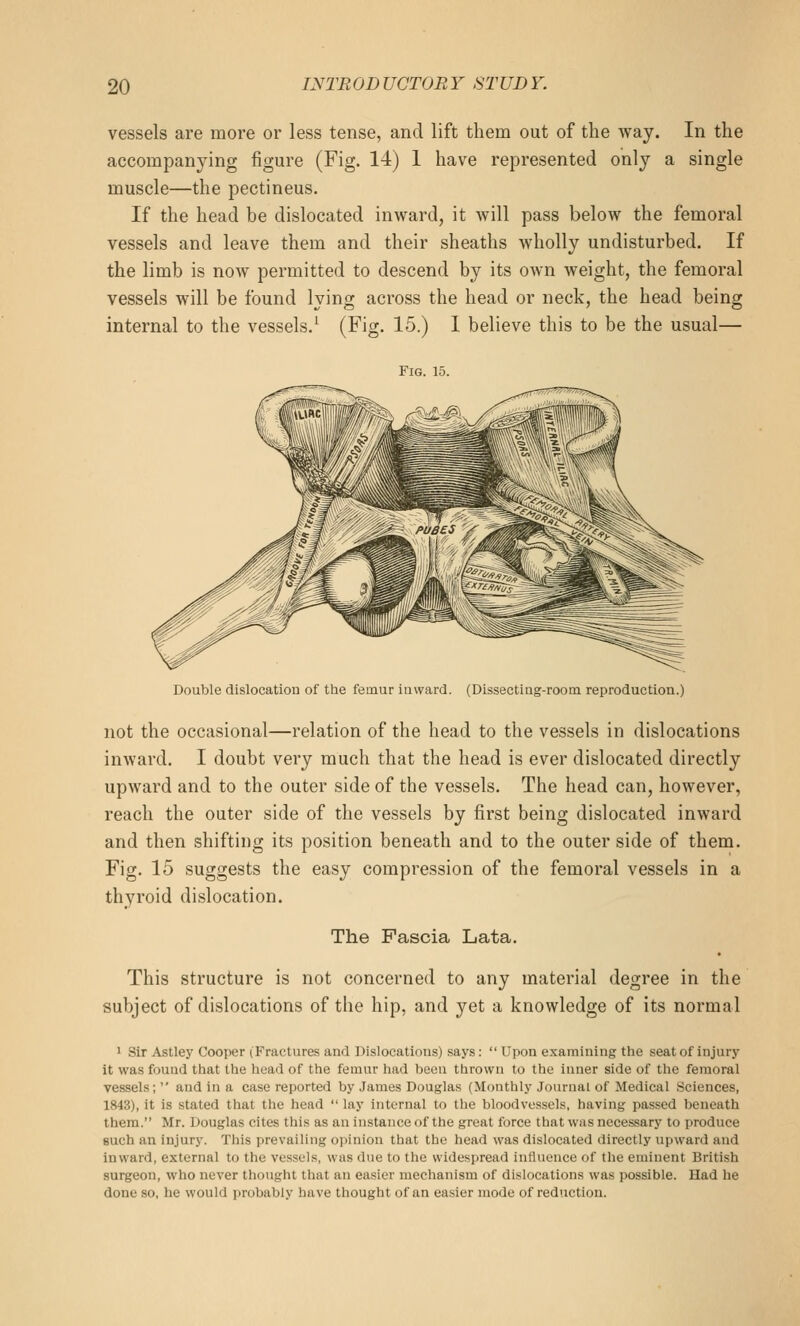 vessels are more or less tense, and lift them out of the way. In the accompanying figure (Fig. 14) 1 have represented only a single muscle—the pectineus. If the head be dislocated inward, it will pass below the femoral vessels and leave them and their sheaths wholly undisturbed. If the limb is now permitted to descend by its own weight, the femoral vessels will be found lying across the head or neck, the head being internal to the vessels.^ (Fig. 15.) 1 believe this to be the usual— Fig. 15. Double dislocation of the femur inward. (Dissecting-room reproduction.) not the occasional—relation of the head to the vessels in dislocations inward. I doubt very much that the head is ever dislocated directly upward and to the outer side of the vessels. The head can, however, reach the outer side of the vessels by first being dislocated inward and then shifting its position beneath and to the outer side of them. Fig. 15 suggests the easy compression of the femoral vessels in a thyroid dislocation. The Fascia Lata. This structure is not concerned to any material degree in the subject of dislocations of the hip, and yet a knowledge of its normal ' Sir Astley Cooper (Fractures and Dislocations) says:  Upon examining the seat of injury it was found that the head of the femur had been thrown to the inner side of the femoral vessels;  and in a case reported by James Douglas (Monthly Journal of Medical Sciences, 1843), it is stated that the head  lay internal to the bloodvessels, having passed beneath them. Mr. Douglas cites this as an instance of the great force that was necessary to produce such an injury. This prevailing opinion that the head was dislocated directly upward and inward, external to the vessels, was due to the widespread influence of the eminent British surgeon, who never thought that an easier mechanism of dislocations was possible. Had he done so, he would ])robably have thought of an easier mode of reduction.