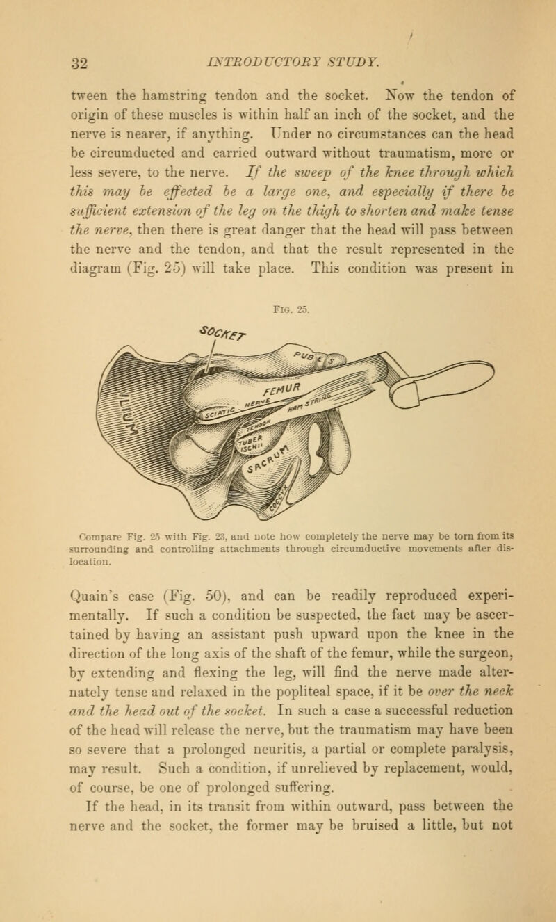 tween the hamstring tendon and the socket. Xow the tendon of origin of these muscles is within half an inch of the socket, and the nerve is nearer, if anything. Under no circumstances can the head he circumducted and carried outward without traumatism, more or less severe, to the nerve. If the sweep of the knee through which this may he effected be a large one, and especially if there he sufficient extension of the leg on the thigh to shorten and make tense the nerve, then there is great danger that the head will pass between the nerve and the tendon, and that the result represented in the diagram (Fig. 25) will take place. This condition was present in Fig. 25. Compare Fig. 2-5 with Fig. Zi, and note how completely the nerve may be torn from its surrounding and controlling attachments through circumductive movements after dis- location. Quain's case (Fig. 50), and can be readily reproduced experi- mentally. If such a condition be suspected, the fact may be ascer- tained by having an assistant push upward upon the knee in the direction of the long axis of the shaft of the femur, while the surgeon, by extending and flexing the leg, will find the nerve made alter- nately tense and relaxed in the popliteal space, if it be over the neck and the head out of the socket. In such a case a successful reduction of the head will release the nerve, but the traumatism may have been 80 severe that a prolonged neuritis, a partial or complete paralysis, may result. Such a condition, if unrelieved by replacement, would, of course, be one of prolonged suffering. If the head, in its transit from within outward, pass between the nerve and the socket, the former may be bruised a little, but not