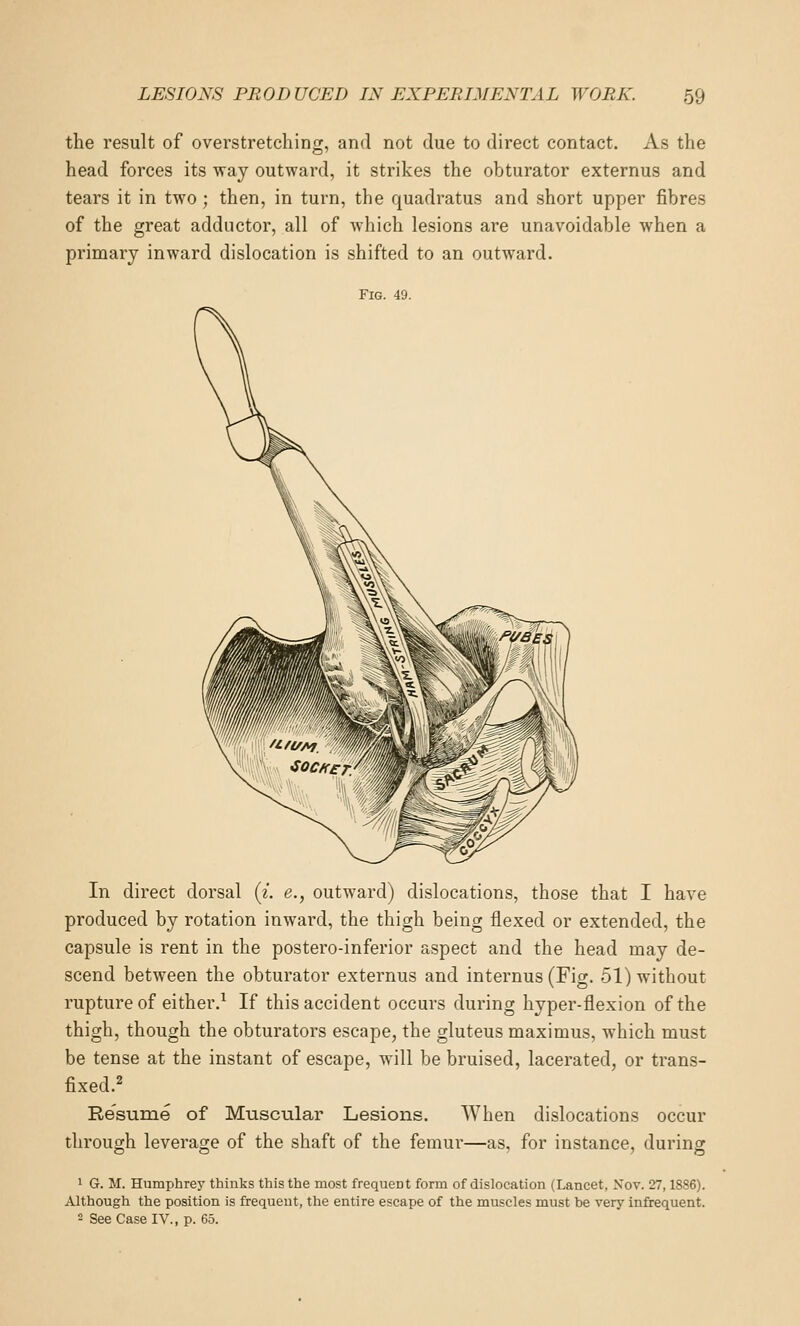 the result of overstretching, and not due to direct contact. As the head forces its way outward, it strikes the obturator externus and tears it in two ; then, in turn, the quadratus and short upper fibres of the great adductor, all of Avhich lesions are unavoidable when a primary inward dislocation is shifted to an outward. Fig. 49. In direct dorsal (i. e., outward) dislocations, those that I have produced by rotation inward, the thigh being flexed or extended, the capsule is rent in the postero-inferior aspect and the head may de- scend between the obturator externus and internus (Fig. 51) without rupture of either.^ If this accident occurs during hyper-flexion of the thigh, though the obturators escape, the gluteus maximus, which must be tense at the instant of escape, will be bruised, lacerated, or trans- fixed.^ Re'sume of Muscular Lesions. When dislocations occur through leverage of the shaft of the femur—as, for instance, during 1 G. M. Humphrey thinks this the most frequent form of dislocation (Lancet, Nov. 27,1886). Although the position is frequent, the entire escape of the muscles must be very infrequent. - See Case IV., p. 65.