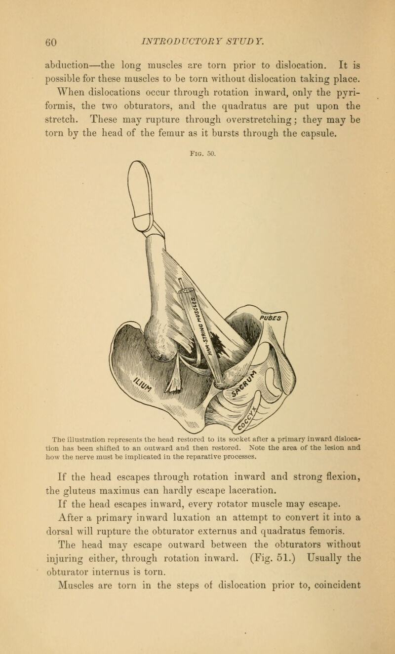 abduction—the long muscles are torn prior to dislocation. It is possible for these muscles to be torn without dislocation taking place. When dislocations occur through rotation inward, only the pyri- formis, the two obturators, and the quadratus are put upon the stretch. These may rupture through overstretching; they may be torn by the head of the femur as it bursts through the capsule. Fig. 50. The illustration represents the head restored to its socket after a primary inward disloca- tion has been shifted to an outward and then restored. Note the area of the lesion and how the nerve must he implicated in the reparative processes. If the head escapes through rotation inward and strong flexion, the gluteus maximus can hardly escape laceration. If the head escapes inward, every rotator muscle may escape. After a primary inward luxation an attempt to convert it into a dorsal will rupture the obturator externus and quadratus femoris. The head may escape outward between the obturators without injuring either, through rotation inward. (Fig. 51.) Usually the obturator internus is torn. Muscles are torn in the steps of dislocation prior to, coincident