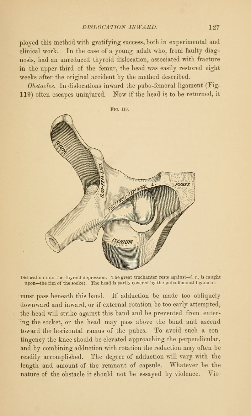 ployed this method with gratifying success, both in experimental and clinical work. In the case of a young adult who, from faulty diag- nosis, had an unreduced thyroid dislocation, associated with fracture in the upper third of the femur, the head was easily restored eight weeks after the original accident by the method described. Obstacles. In dislocations inward the pubo-femoral ligament (Fig. 119) often escapes uninjured. Now if the head is to be returned, it Fig. 119. Dislocation into the thyroid depression. The great trochanter rests against—i. e., is caught upon—the rim of the socket. The head is partly covered by the pubo-femoral ligament. must pass beneath this band. If adduction be made too obliquely downward and inward, or if external rotation be too early attempted, the head will strike against this band and be prevented from enter- ing the socket, or the head may pass above the band and ascend toward the horizontal ramus of the pubes. To avoid such a con- tingency the knee should be elevated approaching the perpendicular, and by combining adduction with rotation the reduction may often be readily accomplished. The degree of adduction will vary with the length and amount of the remnant of capsule. Whatever be the nature of the obstacle it should not be essayed by violence. Vio-