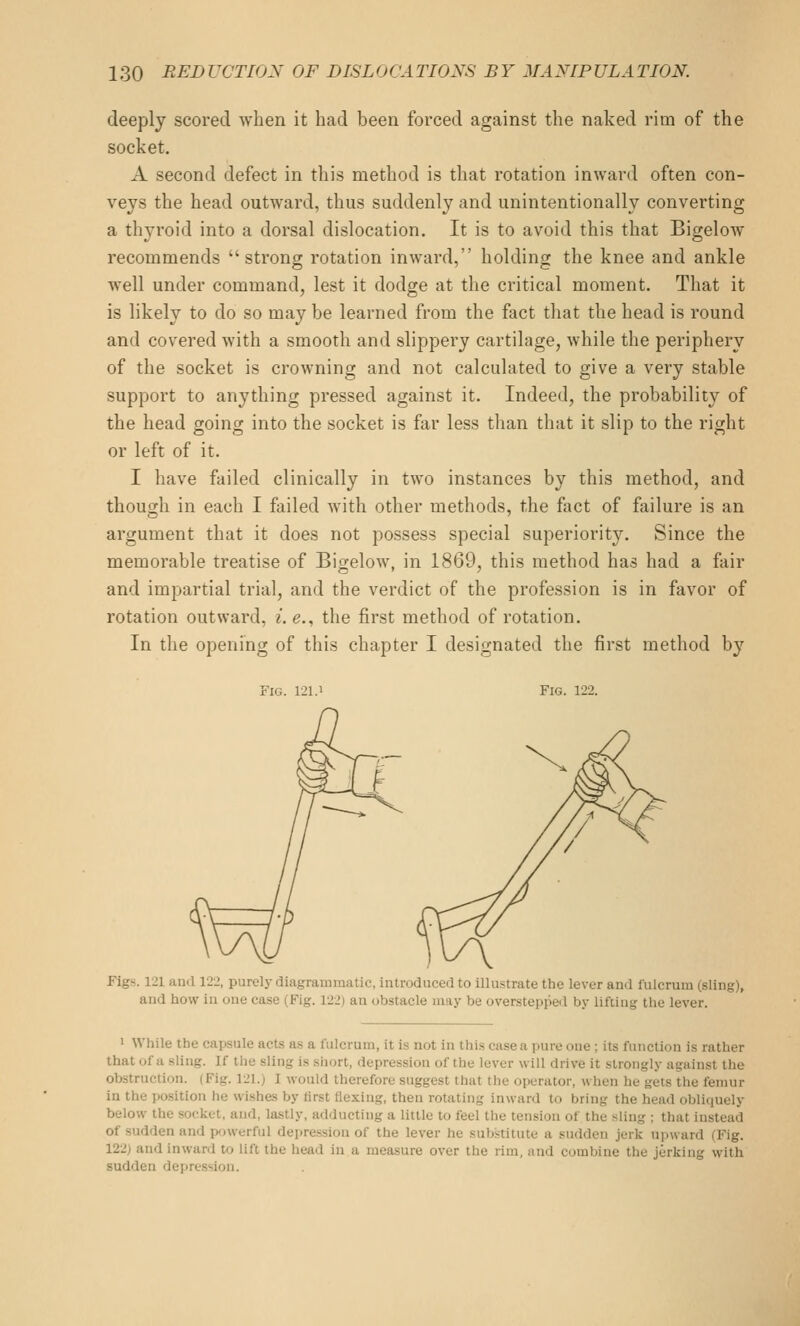 deeply scored when it had been forced against the naked rim of the socket. A second defect in this method is that rotation inward often con- veys the head outward, thus suddenly and unintentionally converting a thyroid into a dorsal dislocation. It is to avoid this that Bigelow recommends strong rotation inward, holding the knee and ankle well under command, lest it dodge at the critical moment. That it is likely to do so may be learned from the fact that the head is round and covered with a smooth and slippery cartilage, while the periphery of the socket is crowning and not calculated to give a very stable support to anything pressed against it. Indeed, the probability of the head going into the socket is far less than that it slip to the right or left of it. I have failed clinically in two instances by this method, and though in each I failed with other methods, the fact of failure is an argument that it does not possess special superiority. Since the memorable treatise of BigeloAv, in 1869, this method has had a fair and impartial trial, and the verdict of the profession is in favor of rotation outward, i. e., the first method of rotation. In the opening of this chapter I designated the first method by Fig. 121.1 Fig. 122. Figs. 121 and 122, purely diagrammatic, introduced to illustrate the lever and fulcrum (sling), and how in one case (Fig. 122) an obstacle may be overstepped by lifting the lever. > While the capsule acts as a fulcrum, it is not in this case a pure one ; its function is rather that of a sling. If the sling is short, depression of the lever will drive it strongly against the obstruction. (Fig. 121.) I would therefore suggest that the operator, when he gets the femur in the position he wishes by tirst flexing, then rotating inward to bring the head obliquely below the socket, and, lastly, adducting a little to feel the tension of the sling ; that instead of sudden and powerful depre.ssion of the lever he substitute a sudden jerk upward (Fig. 122) and inward to lift the head in a measure over the rim, and combine the jerking with sudden depression.