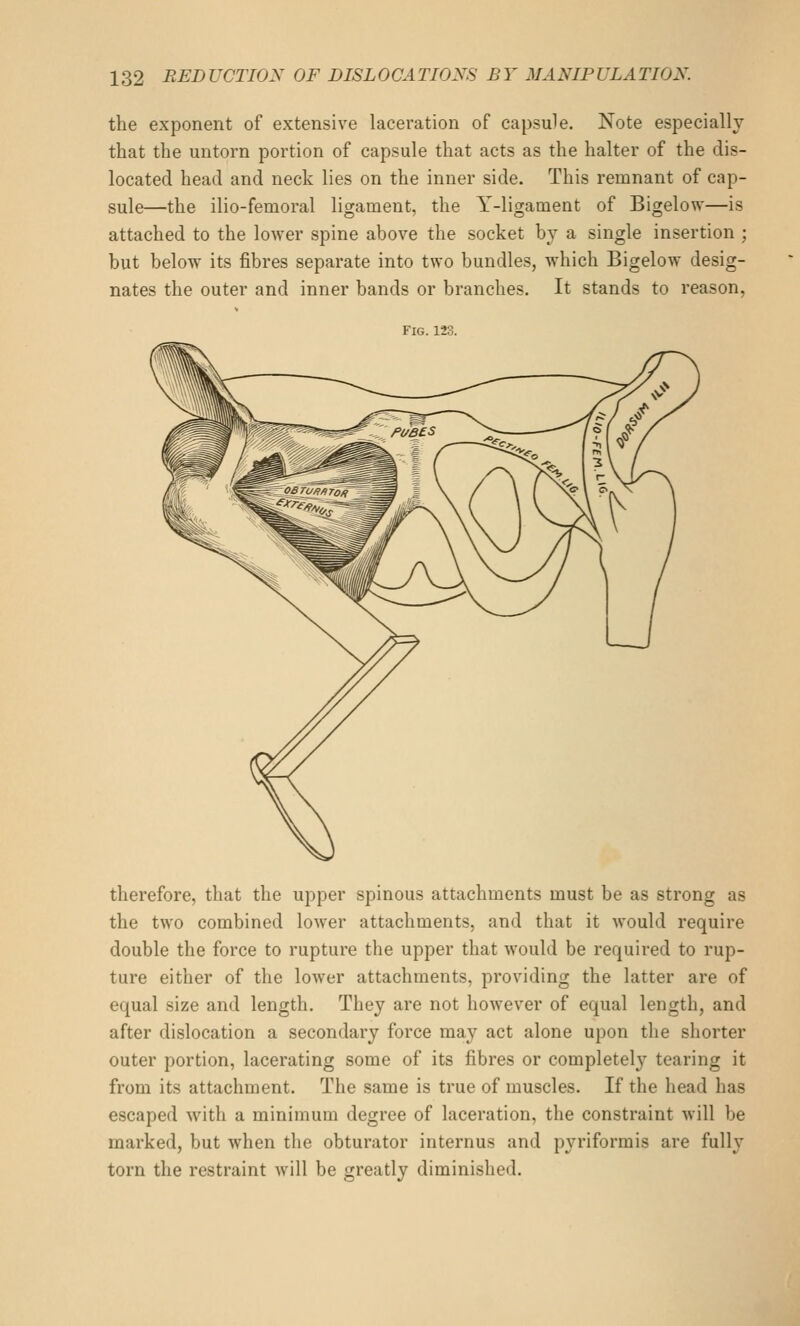 the exponent of extensive laceration of capsule. Note especially that the untorn portion of capsule that acts as the halter of the dis- located head and neck lies on the inner side. This remnant of cap- sule—the ilio-femoral ligament, the Y-ligament of Bigelow—is attached to the lower spine above the socket by a single insertion ; but below its fibres separate into two bundles, which Bigelow desig- nates the outer and inner bands or branches. It stands to reason, Fig. 123. therefore, that the upper spinous attachments must be as strong as the two combined lower attachments, and that it would require double the force to rupture the upper that would be required to rup- ture either of the lower attachments, providing the latter are of equal size and length. They are not however of equal length, and after dislocation a secondary force may act alone upon the shorter outer portion, lacerating some of its fibres or completely tearing it from its attachment. The same is true of muscles. If the head has escaped Avith a minimum degree of laceration, the constraint will be marked, but when the obturator internus and pyriformis are fully torn the restraint will be greatly diminished.