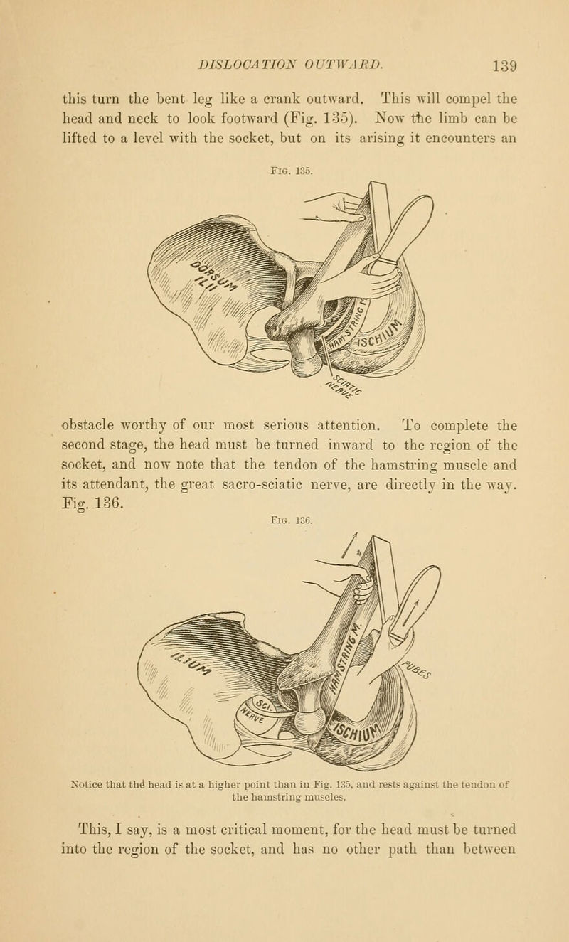 this turn the Lent leg like a crank outward. This will compel the head and neck to look footward (Fig. 135). Now tiie limb can be lifted to a level with the socket, but on its arising it encounters an Fig. 135. obstacle worthy of our most serious attention. To complete the second stage, the head must be turned inward to the region of the socket, and now note that the tendon of the hamstring muscle and its attendant, the great sacro-sciatic nerve, are directly in the way. Fig. 136. Fl(i. 136. Notice that thd head is at a higher point than in Fig. 135. and rests against the tendon of the hamstring muscles. This, I say, is a most critical moment, for the head must be turned into the region of the socket, and has no other path than between