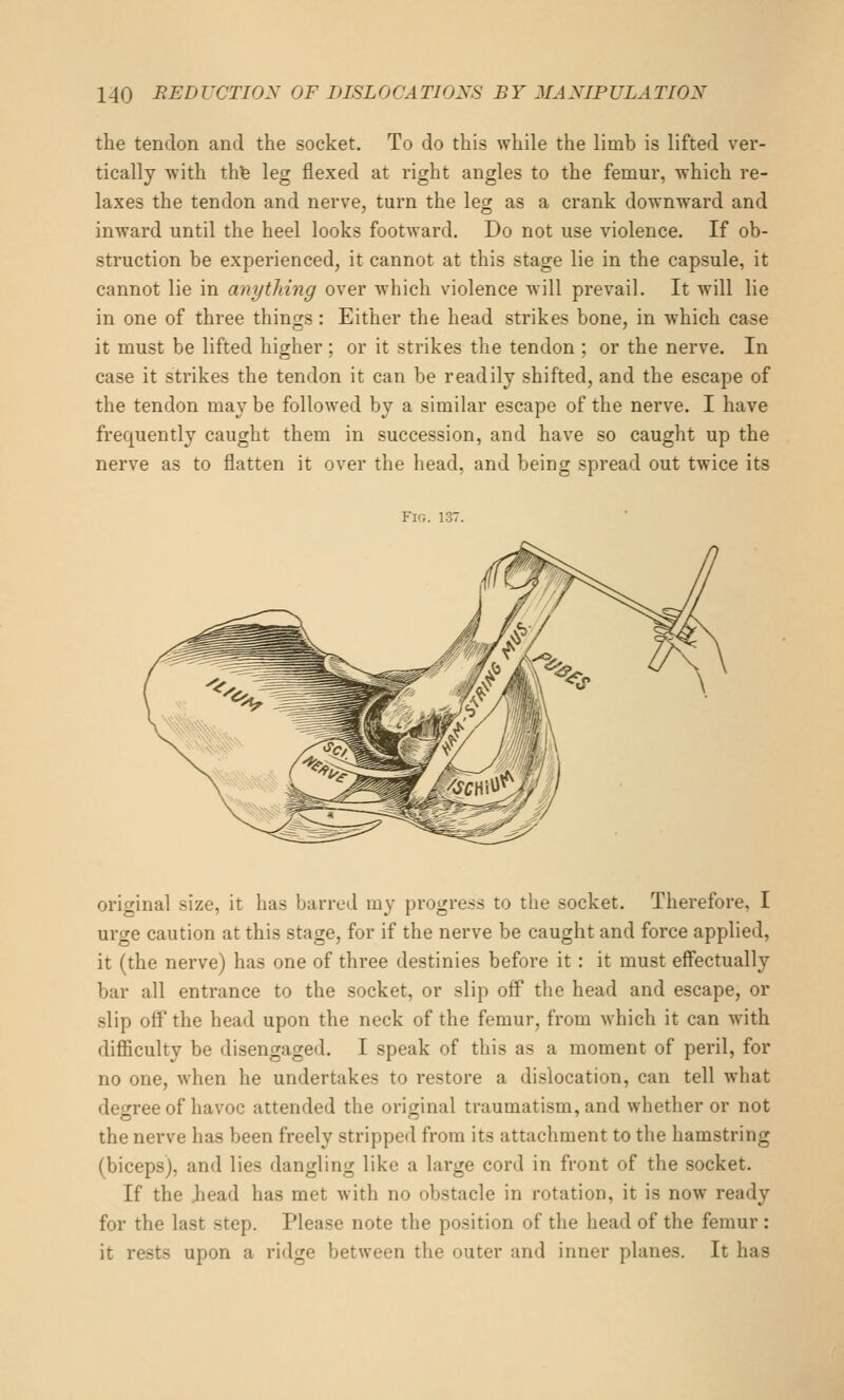 the tendon and the socket. To do this while the limb is lifted ver- tically with thfe leg flexed at right angles to the femur, which re- laxes the tendon and nerve, turn the leg as a crank downward and inward until the heel looks footward. Do not use violence. If ob- struction be experienced, it cannot at this stage lie in the capsule, it cannot lie in anytJiing over which violence will prevail. It will lie in one of three things: Either the head strikes bone, in which case it must be lifted higher ; or it strikes the tendon ; or the nerve. In case it strikes the tendon it can be readily shifted, and the escape of the tendon may be followed by a similar escape of the nerve. I have frequently caught them in succession, and have so caught up the nerve as to flatten it over the head, and being spread out twice its Fig. 137 original size, it has barred my progress to the socket. Therefore, I urge caution at this stage, for if the nerve be caught and force applied, it (the nerve) has one of three destinies before it: it must effectually bar all entrance to the socket, or slip off the head and escape, or slip off the head upon the neck of the femur, from which it can with diflBculty be disengaged. I speak of this as a moment of peril, for no one, when he undertakes to restore a dislocation, can tell what degree of havoc attended the original traumatism, and whether or not the nerve has been freely stripped from its attachment to the hamstring (biceps), and lies dangling like a large cord in front of the socket. If the iiead has met with no obstacle in rotation, it is now ready for the last step. Please note the position of the head of the femur: it rests upon a ridge between the outer and inner planes. It has