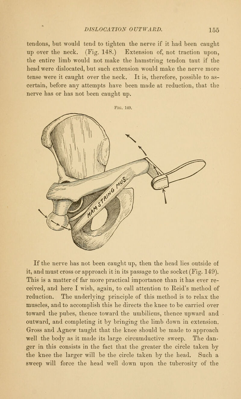 tendons, but would tend to tighten the nerve if it had been caught up over the neck. (Fig. 148.) Extension of, not traction upon, the entire limb would not make the hamstring- tendon taut if the head were dislocated, but such extension would make the nerve more tense were it caught over the neck. It is, therefore, possible to as- certain, before any attempts have been made at reduction, that the nerve has or has not been caught up. Fig. 149. If the nerve has not been caught up, then the head lies outside of it, and must cross or approach it in its passage to the socket (Fig. 149). This is a matter of far more practical importance than it has ever re- ceived, and here I wish, again, to call attention to Reid's method of reduction. The underlying principle of this method is to relax the muscles, and to accomplish this he directs the knee to be carried over toward the pubes, thence toward the umbilicus, thence upward and outward, and completing it by bringing the limb down in extension. Gross and Agnew taught that the knee should be made to approach well the body as it made its large circumductive sweep. The dan- ger in this consists in the fact that the greater the circle taken by the knee the larger will be the circle taken by the head. Such a sweep will force the head well down upon the tuberosity of the