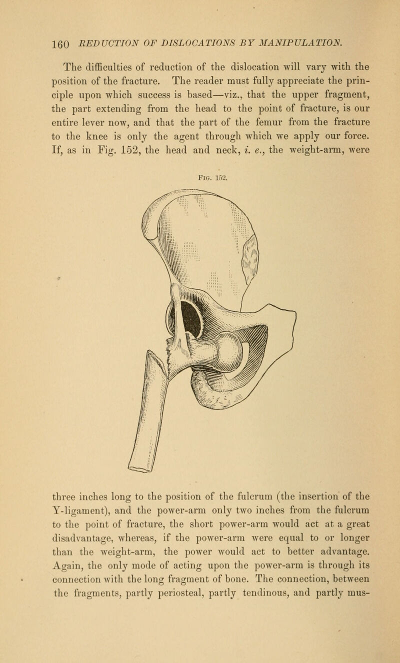 The difficulties of reduction of the dislocation will vary with the position of the fracture. The reader must fully appreciate the prin- ciple upon which success is based—viz., that the upper fragment, the part extending from the head to the point of fracture, is our entire lever now, and that the part of the femur from the fracture to the knee is only the agent through which we apply our force. If, as in Fig. 152, the head and neck, i. e., the weight-arm, were Fig. 152. three inches long to the position of the fulcrum (the insertion of the Y-ligament), and the power-arm only two inches from the fulcrum to the point of fracture, the short poAver-arm would act at a great disadvantage, whereas, if the power-arm were equal to or longer than the weight-arm, the power would act to better advantage. Again, the only mode of acting upon the power-arm is through its connection with the long fragment of bone. The connection, between the fragments, partly periosteal, partly tendinous, and partly mus-