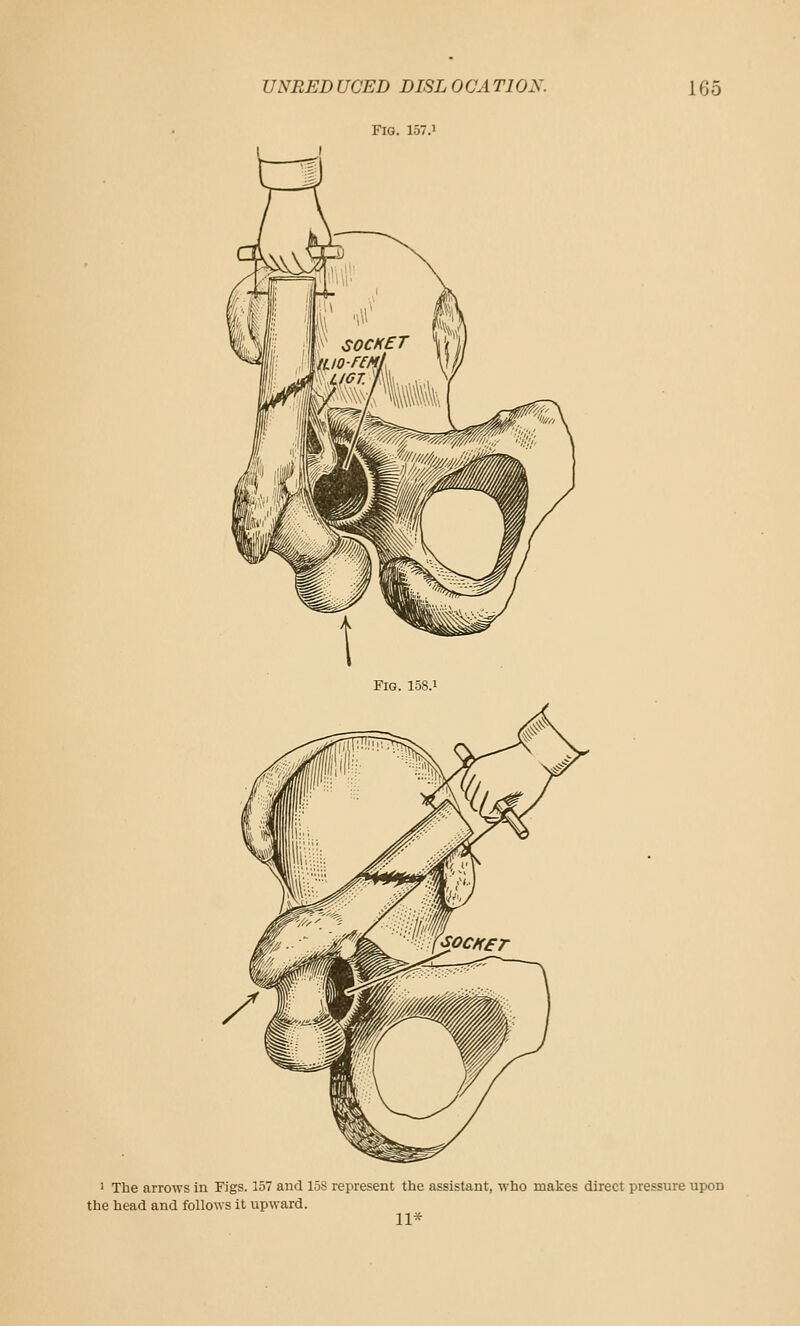 UNRED UCED DISL 0CA TION. Fig. 157.1 165 I The arrows in Figs. 157 and 158 represent the assistant, who makes direct pressure upon the head and follows it upward. 11*