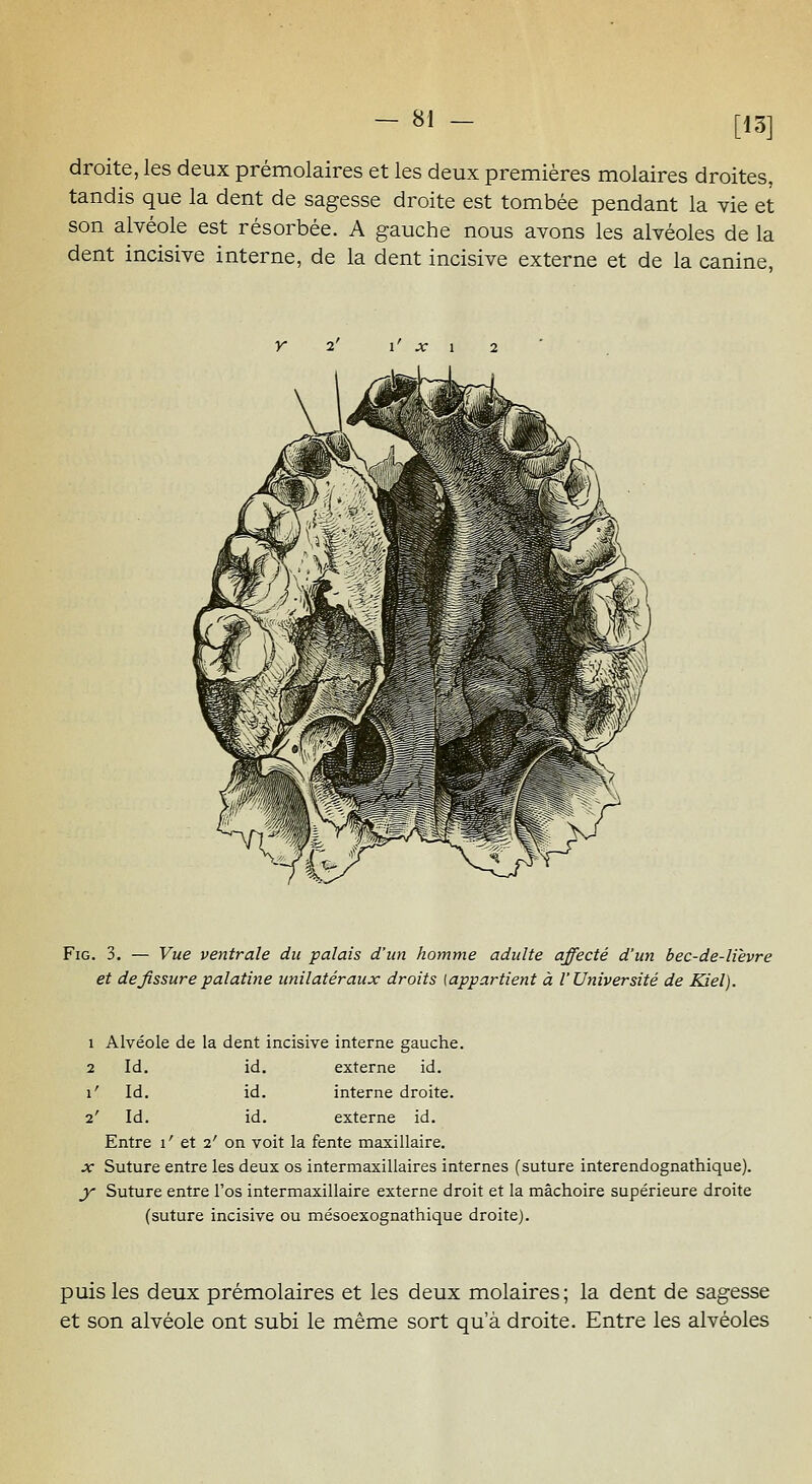 m droite, les deux prémolaires et les deux premières molaires droites, tandis que la dent de sagesse droite est tombée pendant la vie et son alvéole est résorbée. A gauche nous avons les alvéoles de la dent incisive interne, de la dent incisive externe et de la canine, r 2' 1' ;c 1 2 x^^^^ FiG. 3. — Vue ventrale du palais d'un homme adulte affecté d'un bec-de-lièvre et de fissure palatine unilatéraux droits (appartient à V Université de Kiel). 1 Alvéole de la dent incisive interne gauche. 2 Id. id. externe id. 1' Id. id. interne droite. 2' Id. id. externe id. Entre 1' et 2' on voit la fente maxillaire. X Suture entre les deux os intermaxillaires internes (suture interendognathique). y Suture entre l'os intermaxillaire externe droit et la mâchoire supérieure droite (suture incisive ou mésoexognathique droite). puis les deux prémolaires et les deux molaires ; la dent de sagesse et son alvéole ont subi le même sort qu'à droite. Entre les alvéoles
