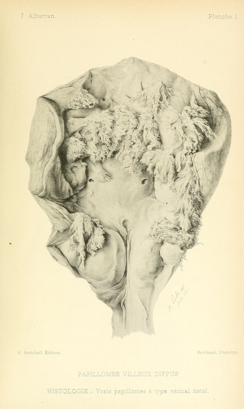 G. Steinheil. Éditeur. Beithavttl. Pho; PAhill.Omii;s vli.ijii;D a. dih'FuS HISTOLOGIE : Vrais papiîlomes à type vésical iceîal.