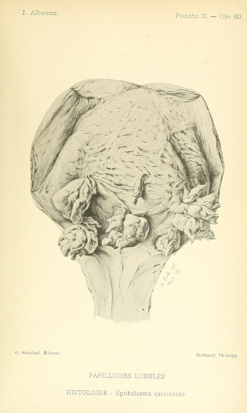 Planche II. — Obs. 60. G. Stcinheil. Éditeur. Bui-th.ind. rhototyp. PAPILLOMES LOBULES HISTOLOGIE : Épithélioma carcinoïde.