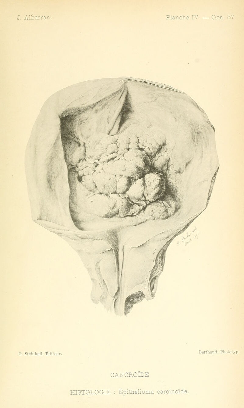 G. Steinheil, Éditeur. Berthaucl. Phototyp. CANCROÏDÈ HISTOLOGIS : Épitiiélioma carcinoïde.