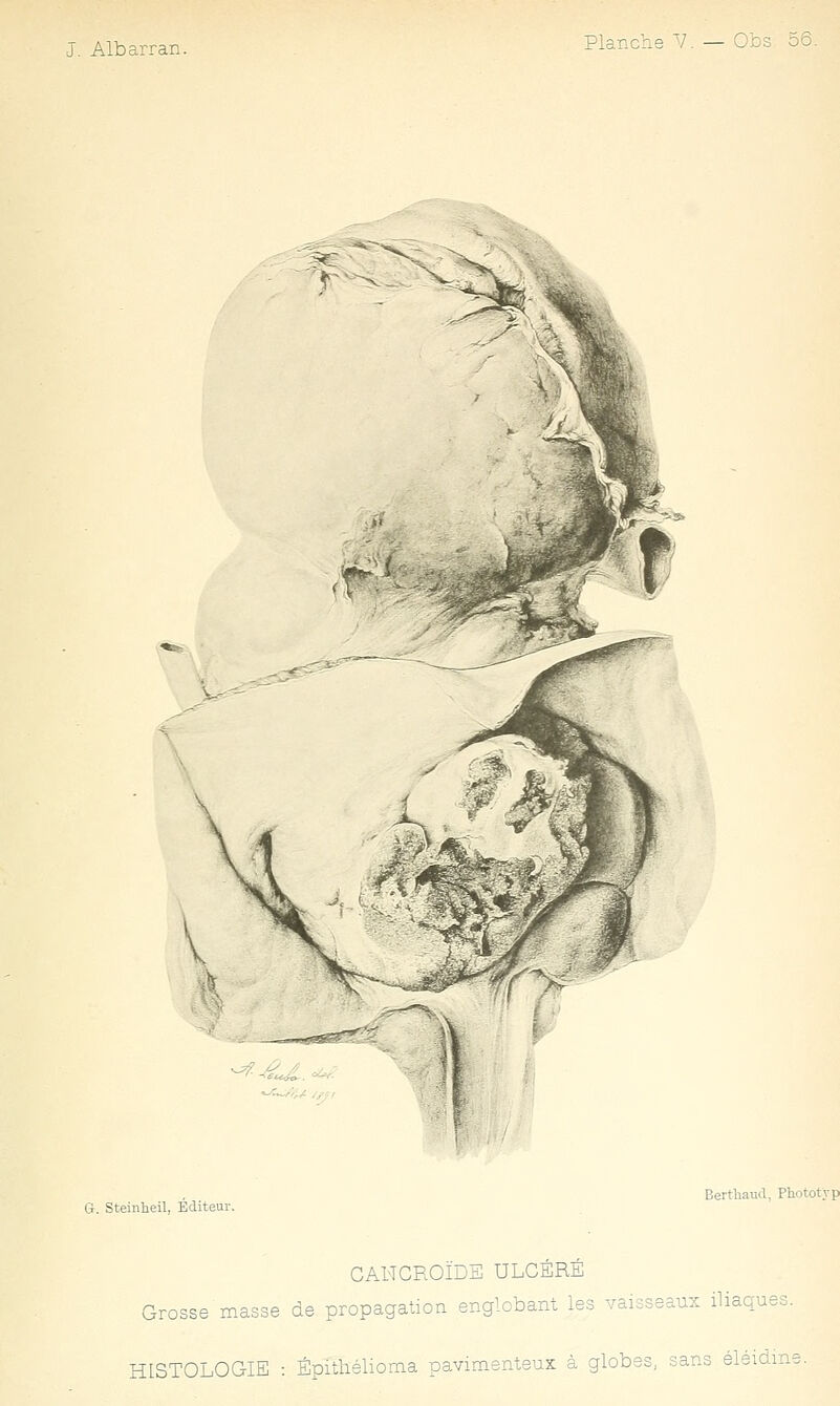 G. Steinheil, Editeur. Berthaud, Photottp CAHCROÏDE ULCÉRÉ Grosse masse de propagation englobant les vaisseaux iliaques. HISTOLOGIE : Épitiiélioma pavimenteus à globes, sans éleidms