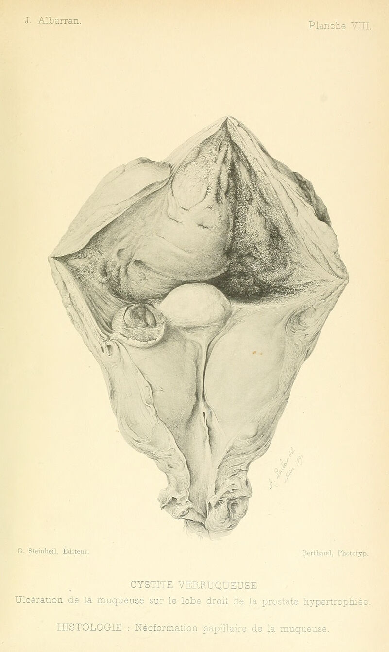 Planche VIII. G. Steiuheil. Éditeur Btithaud. Phùtotyp. CYSTITE VERRUQUSUSE Ulcération de la muqueuse sur le lobe droit de la prostate hypertrophi HISTOLOGIE : Néoformation papillaire de la m-uqueuse.