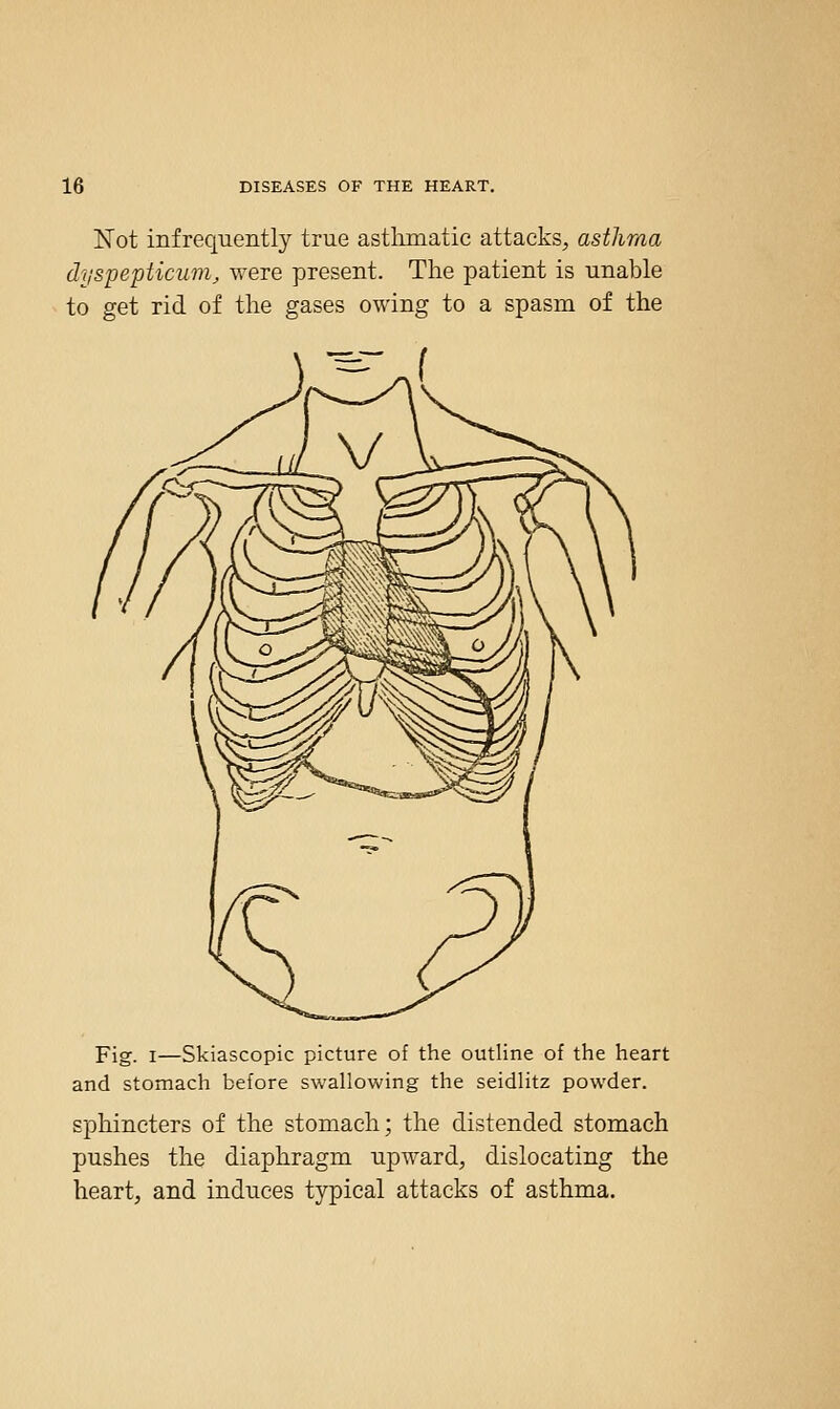Not infrequently true astlimatic attacks, asthma dyspepticum, were present. The patient is unable to get rid of the gases owing to a spasm of the Fig. I—Skiascopic picture of the outline of the heart and stomach before swallowing the seidlitz powder. sphincters of the stomach; the distended stomach pushes the diaphragm upward, dislocating the heart, and induces typical attacks of asthma.