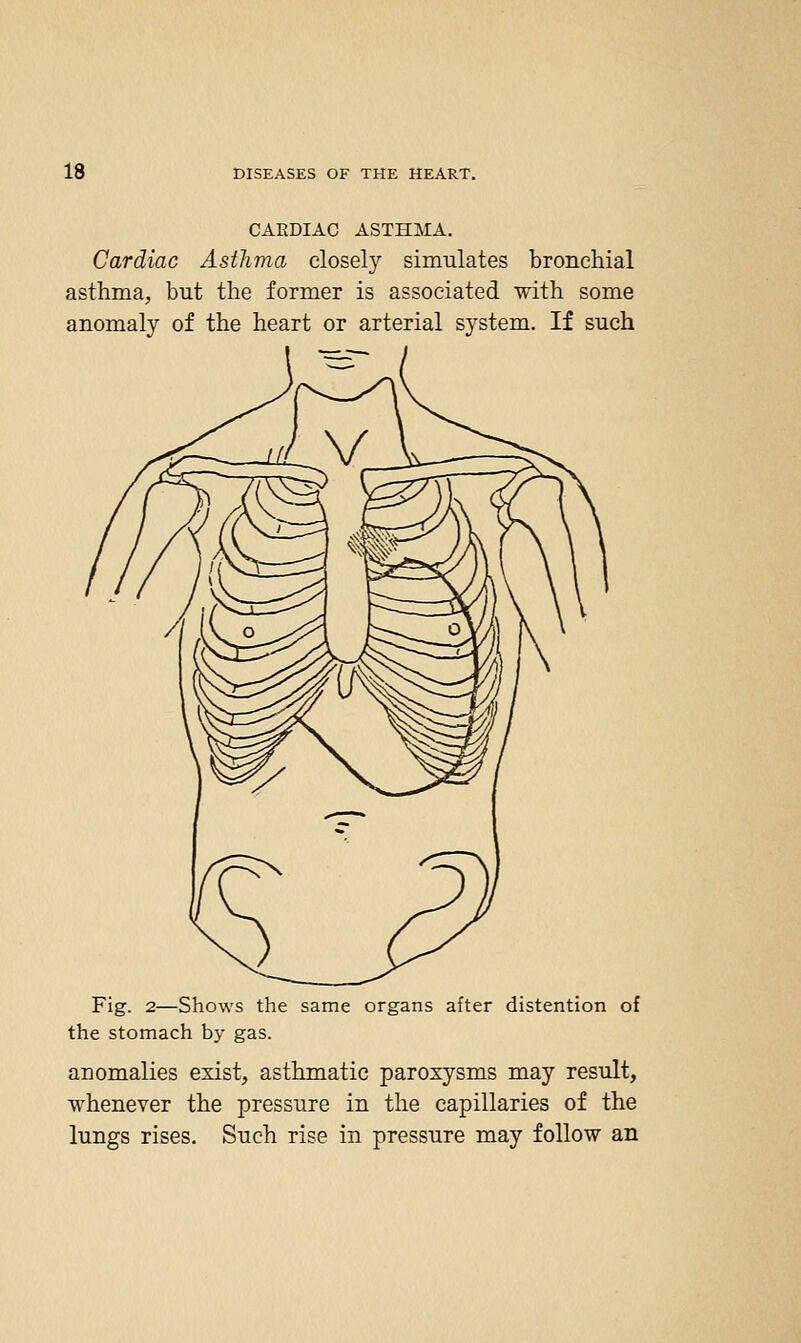 CAKDIAC ASTHMA. Cardiac Asthma closely simulates bronchial asthma, but the former is associated with some anomaly of the heart or arterial system. If such Fig. 2—Shows the same organs after distention of the stomach by gas. anomalies exist, asthmatic paroxysms may result, whenever the pressure in the capillaries of the lungs rises. Such rise in pressure may follow an