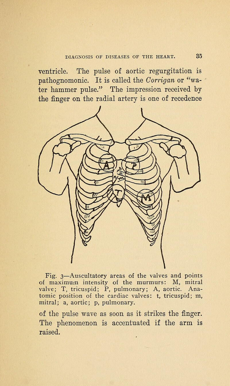 ventricle. The pulse of aortic regurgitation is pathognomonic. It is called the Corrigan or wa- ter hammer pulse. The impression received by the finger on the radial artery is one of recedence Fig. 3—Auscultatory areas of the valves and points of maximum intensity of the murmurs: M, mitral valve; T, tricuspid; P, pulmonary; A, aortic. Ana- tomic position of the cardiac valves: t, tricuspid; m, mitral; a, aortic; p, pulmonary. of the pulse wave as soon as it strikes the finger. The phenomenon is accentuated if the arm is raised.