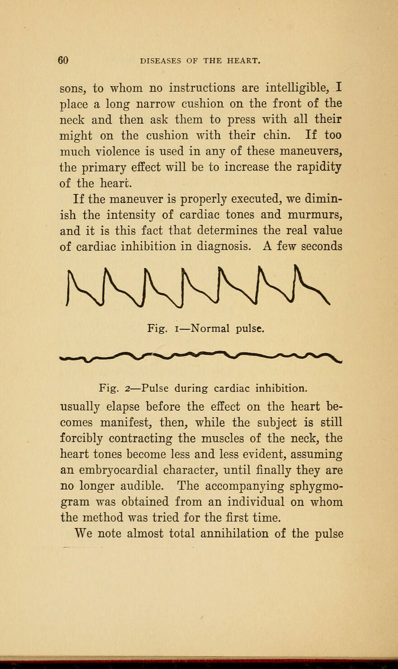 sons, to whom no instructions are intelligible, I place a long narrow cushion on the front of the neck and then ask them to press with all their might on the cushion with their chin. If too much violence is used in any of these maneuvers, the primary effect will be to increase the rapidity of the heart. If the maneuver is properly executed, we dimin- ish the intensity of cardiac tones and murmurs, and it is this fact that determines the real value of cardiac inhibition in diagnosis. A few seconds Fig. I—Normal pulse. Fig. 2—Pulse during cardiac inhibition, usually elapse before the effect on the heart be- comes manifest, then, while the subject is still forcibly contracting the muscles of the neck, the heart tones become less and less evident, assuming an embryocardial character, until finally they are no longer audible. The accompanying sphygmo- gram was obtained from an individual on whom the method was tried for the first time. We note almost total annihilation of the pulse