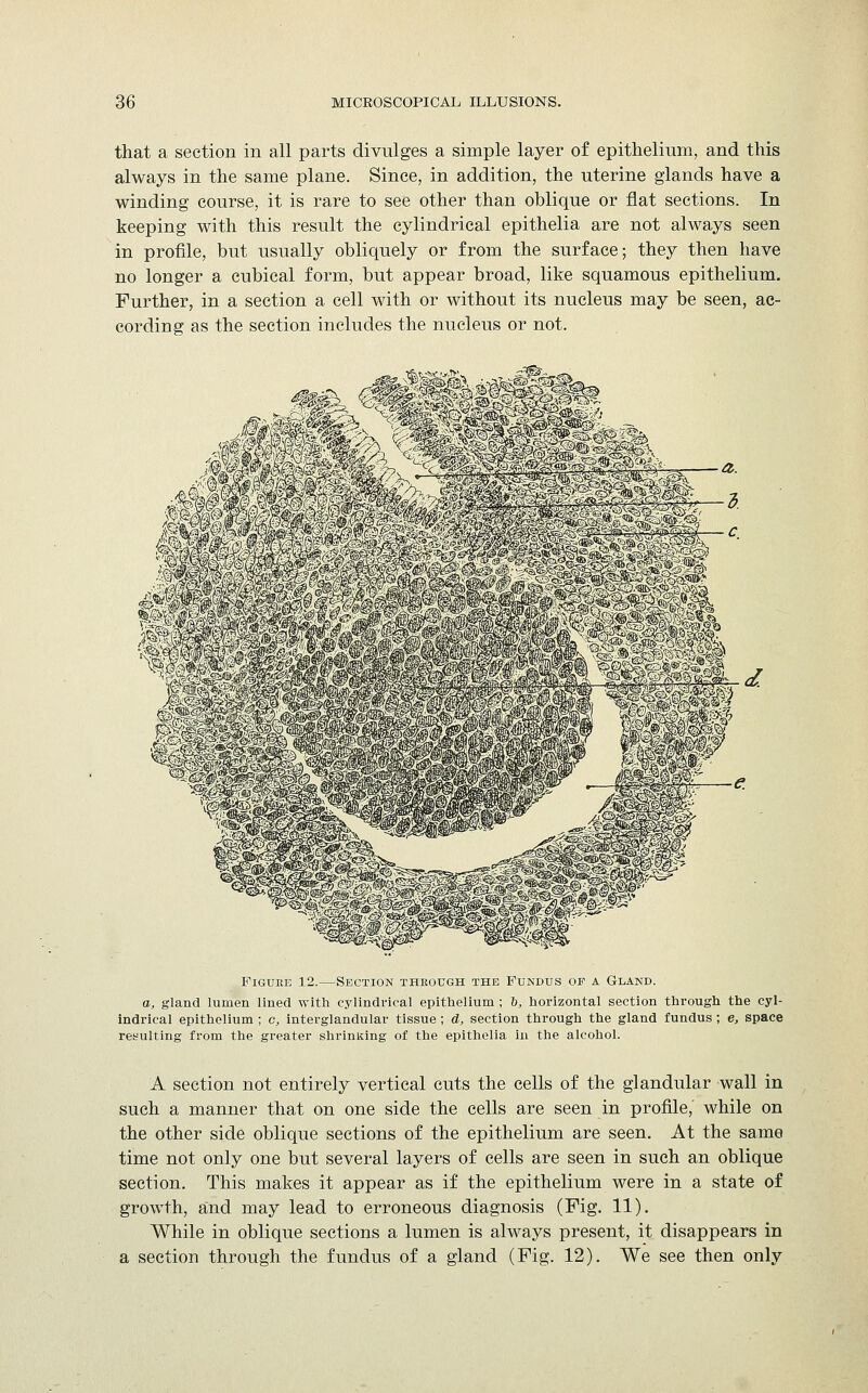 that a section in all parts divulges a simple layer of epithelium, and this always in the same plane. Since, in addition, the uterine glands have a winding course, it is rare to see other than oblique or flat sections. In keeping with this result the cylindrical epithelia are not always seen in profile, but usually obliquely or from the surface; they then have no longer a cubical form, but appear broad, like squamous epithelium. Further, in a section a cell with or without its nucleus may be seen, ac- cording as the section includes the nucleus or not. WMKmBm Figure 12.—Section through the Fundus of a Gland. a, gland lumen lined with cylindrical epithelium ; 6, horizontal section through the cyl- indrical epithelium ; c, interglandular tissue ; d, section through the gland fundus ; e, space resulting from the greater shrinking of the epithelia in the alcohol. A section not entirely vertical cuts the cells of the glandular wall in such a manner that on one side the cells are seen in profile, while on the other side oblique sections of the epithelium are seen. At the same time not only one but several layers of cells are seen in such an oblique section. This makes it appear as if the epithelium were in a state of growth, and may lead to erroneous diagnosis (Fig. 11). While in oblique sections a lumen is always present, it disappears in a section through the fundus of a gland (Fig. 12). We see then only