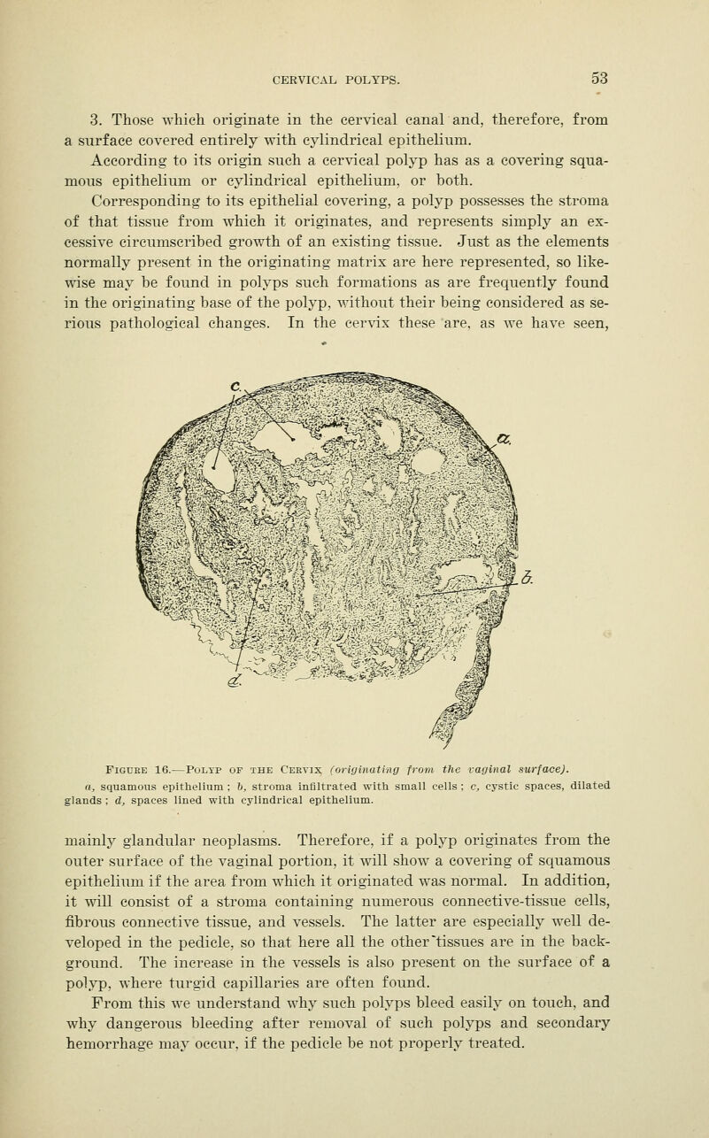 3. Those which originate in the cervical canal and, therefore, from a surface covered entirely with cylindrical epithelium. According to its origin such a cervical polyp has as a covering squa- mous epithelium or cylindrical epithelium, or both. Corresponding to its epithelial covering, a polyp possesses the stroma of that tissue from which it originates, and represents simply an ex- cessive circumscribed growth of an existing tissue. Just as the elements normally present in the originating matrix are here represented, so like- wise may be found in polyps such formations as are frequently found in the originating base of the polyp, without their being considered as se- rious pathological changes. In the cervix these are, as we have seen, Figure 16.—Polyp of the Cervix (originating from the vaginal surface), a, squamous epithelium ; b, stroma infiltrated with small cells : c, cystic spaces, dilated glands ; d, spaces lined with cylindrical epithelium. mainly glandular neoplasms. Therefore, if a polyp originates from the outer surface of the vaginal portion, it will show a covering of squamous epithelium if the area from which it originated was normal. In addition, it will consist of a stroma containing numerous connective-tissue cells, fibrous connective tissue, and vessels. The latter are especially well de- veloped in the pedicle, so that here all the other tissues are in the back- ground. The increase in the vessels is also present on the surface of a polyp, where turgid capillaries are often found. From this we understand why such polyps bleed easily on touch, and why dangerous bleeding after removal of such polyps and secondary hemorrhage may occur, if the pedicle be not properly treated.