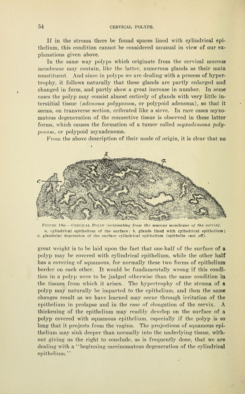 If in the stroma there be found spaces lined with cylindrical epi- thelium, this condition cannot be considered unusual in view of our ex- planations given above. In the same way polyps which originate from the cervical mucous membrane may contain, like the latter, numerous glands as their main constituent. And since in polyps we are dealing with a process of hyper- trophy, it follows naturally that these glands are partly enlarged and changed in form, and partly show a great increase in number. In some cases the polyp may consist almost entirely of glands with very little in- terstitial tissue (adenoma polyposum, or polypoid adenoma), so that it seems, on transverse section, cribrated like a sieve. In rare cases myxo- matous degeneration of the connective tissue is observed in these latter forms, which causes the formation of a tumor called myxadenoma poly- posum, or polypoid myxadenoma. From the above description of their mode of origin, it is clear that no Figure 16a.—Cervical Polyp (originating from the mucous membrane of the cervix), a, cylindrical epithelium of the surface : b, glands lined with cylindrical epithelium: c, glandular depression of the surface cylindrical epithelium (epithelia cast off). great weight is to be laid upon the fact that one-half of the surface of a polyp may be covered with cylindrical epithelium, while the other half has a covering of squamous, for normally these two forms of epithelium border on each other. It would be fundamentally wrong if this condi- tion in a polyp were to be judged otherwise than the same condition in the tissues from which it arises. The hypertrophy of the stroma of a polyp may naturally be imparted to the epithelium, and then the same changes result as we have learned may occur through irritation of the epithelium in prolapse and in the case of elongation of the cervix. A thickening of the epithelium may readily develop on the surface of a polyp covered with squamous epithelium, especially if the polyp is so long that it projects from the vagina. The projections of squamous epi- thelium may sink deeper than normally into the underlying tissue, with- out giving us the right to conclude, as is frequently done, that we are dealing with a '' beginning carcinomatous degeneration of the cylindrical epithelium.