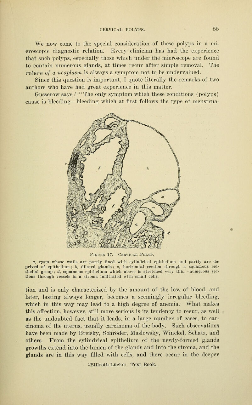 We now come to the special consideration of these polyps in a mi- croscopic diagnostic relation. Every clinician has had the experience that snch polyps, especially those which nnder the microscope are found to contain numerous glands, at times recur after simple removal. The return of a neoplasm is always a symptom not to be undervalued. Since this question is important, I quote literally the remarks of two authors who have had great experience in this matter. Gusserow says i1 The only symptom which these conditions (polyps) cause is bleeding—bleeding which at first follows the type of menstrua- Figure 17.—Cervical Polyp. a, cysts whose walls are partly lined with cylindrical epithelium and partly are de- prived of epithelium; i, dilated glands; c, horizontal section through a squamous epi- thelial group ; d, squamous epithelium which above is stretched very thin -numerous sec- tions through vessels in a stroma infiltrated with small cells. tion and is only characterized by the amount of the loss of blood, and later, lasting always longer, becomes a seemingly irregular bleeding, which in this way may lead to a high degree of anemia. What makes this affection, however, still more serious is its tendency to recur, as well as the undoubted fact that it leads, in a large number of cases, to car- cinoma of the uterus, usually carcinoma of the body. Such observations have been made by Breisky, Schroder, Maslowsky, Winckel, Schatz, and others. From the cylindrical epithelium of the newly-formed glands growths extend into the lumen of the glands and into the stroma, and the glands are in this way filled with cells, and there occur in the deeper iBillroth-Lucke: Text Book.