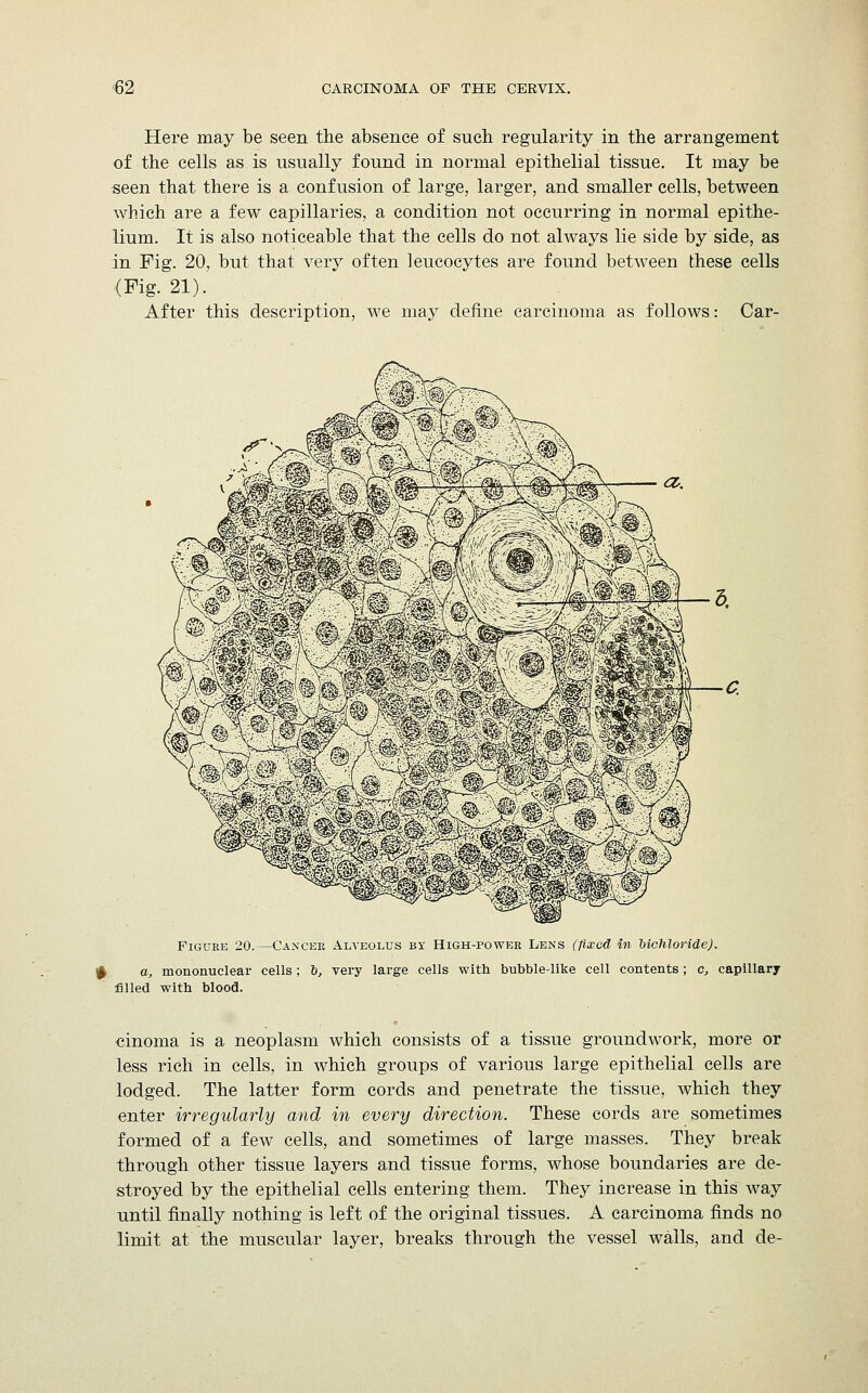 Here may be seen the absence of such regularity in the arrangement of the cells as is usually found in normal epithelial tissue. It may be seen that there is a confusion of large, larger, and smaller cells, between which are a few capillaries, a condition not occurring in normal epithe- lium. It is also noticeable that the cells do not always lie side by side, as in Fig. 20, but that very often leucocytes are found between these cells (Fig. 21). After this description, we may define carcinoma as follows: Car- Figuke 20.—Cancek Alveolus bi* High-power Lens (fixed in bichloride). + a, mononuclear cells ; 6, very large cells with bubble-like cell contents; c, capillary filled with blood. cinoma is a neoplasm which consists of a tissue groundwork, more or less rich in cells, in which groups of various large epithelial cells are lodged. The latter form cords and penetrate the tissue, which they enter irregularly and in every direction. These cords are sometimes formed of a few cells, and sometimes of large masses. They break through other tissue layers and tissue forms, whose boundaries are de- stroyed by the epithelial cells entering them. They increase in this way until finally nothing is left of the original tissues. A carcinoma finds no limit at the muscular layer, breaks through the vessel walls, and de-