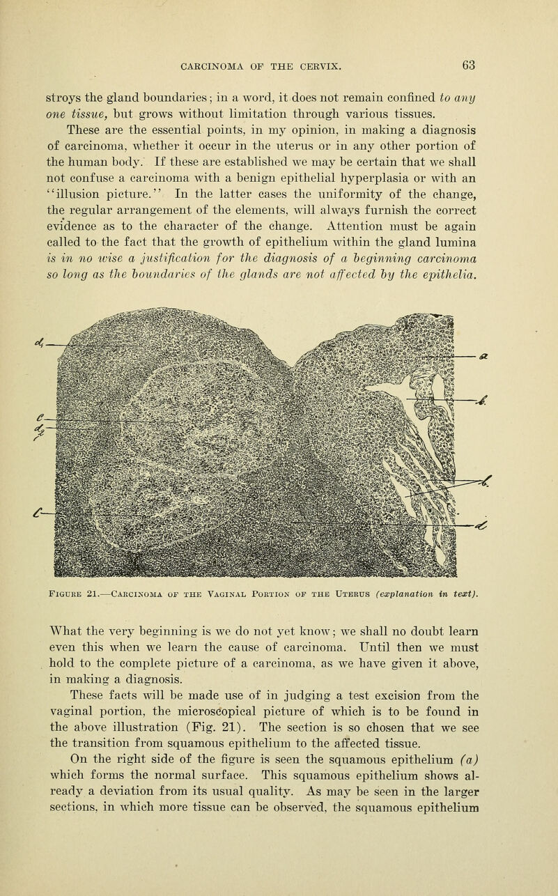 stroys the gland boundaries; in a word, it does not remain confined to any one tissue, but grows without limitation through various tissues. These are the essential points, in my opinion, in making a diagnosis of carcinoma, whether it occur in the uterus or in any other portion of the human body. If these are established we may be certain that we shall not confuse a carcinoma with a benign epithelial hyperplasia or with an illusion picture. In the latter cases the uniformity of the change, the regular arrangement of the elements, will always furnish the correct evidence as to the character of the change. Attention must be again called to the fact that the growth of epithelium within the gland lumina is in no wise a justification for the diagnosis of a beginning carcinoma so long as the boundaries of the glands are not affected by the epithelia. Figure 21.—Carcinoma of the Vaginal Portion of the Uterus (explanation in text). What the very beginning is we do not yet know; we shall no doubt learn even this when we learn the cause of carcinoma. Until then we must hold to the complete picture of a carcinoma, as we have given it above, in making a diagnosis. These facts will be made use of in judging a test excision from the vaginal portion, the microscopical picture of which is to be found in the above illustration (Fig. 21). The section is so chosen that we see the transition from squamous epithelium to the affected tissue. On the right side of the figure is seen the squamous epithelium (a) which forms the normal surface. This squamous epithelium shows al- ready a deviation from its usual quality. As may be seen in the larger sections, in which more tissue can be observed, the squamous epithelium