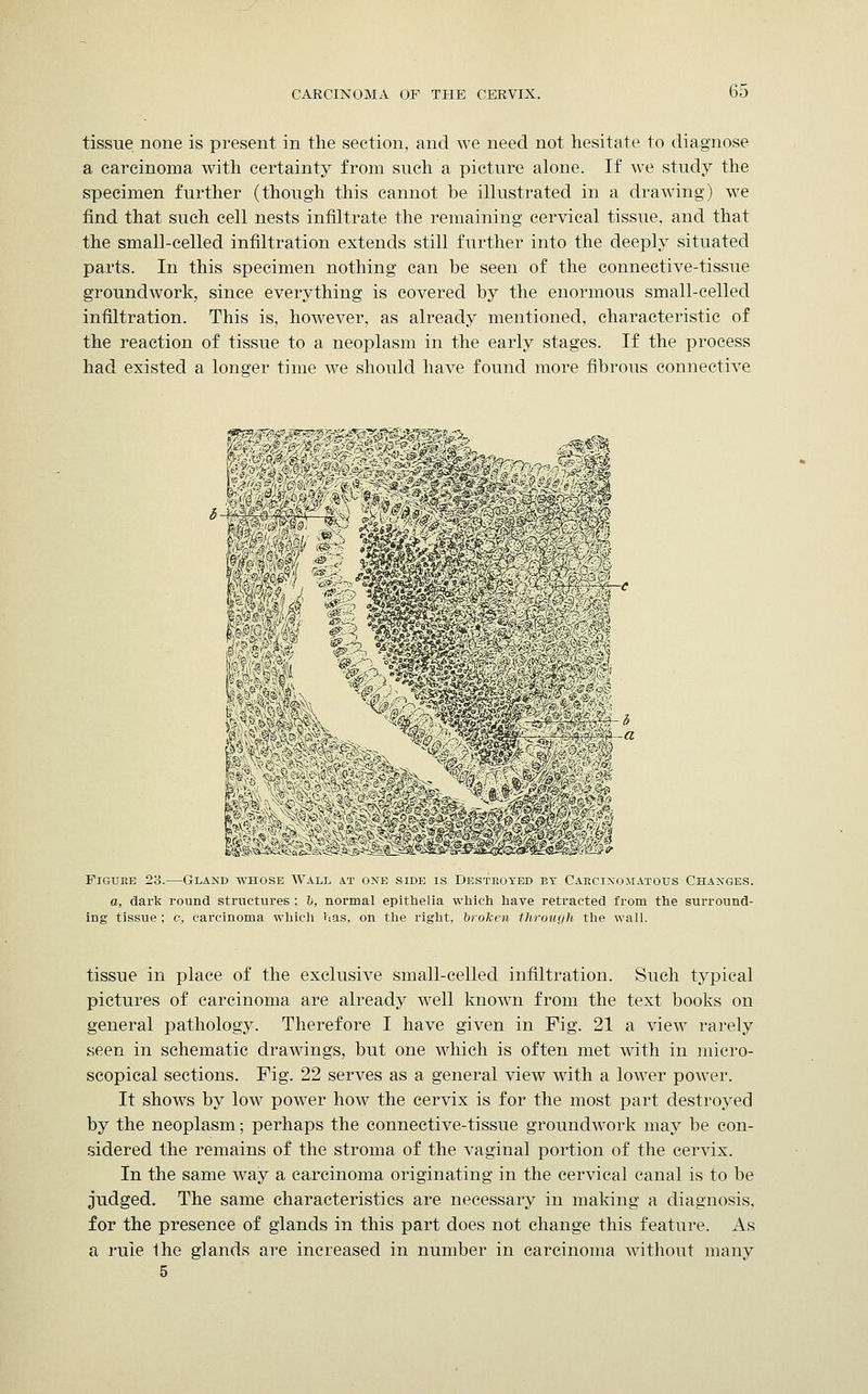 tissue none is present in the section, and we need not hesitate to diagnose a carcinoma with certainty from such'a picture alone. If we study the specimen further (though this cannot be illustrated in a drawing) we find that such cell nests infiltrate the remaining cervical tissue, and that the small-celled infiltration extends still further into the deeply situated parts. In this specimen nothing can be seen of the connective-tissue groundwork, since everything is covered by the enormous small-celled infiltration. This is, however, as already mentioned, characteristic of the reaction of tissue to a neoplasm in the early stages. If the process had existed a longer time we should have found more fibrous connective Figure 23.—Gland whose Wall at one side is Destroyed by Carcinomatous Changes. a, dark round structures : b, normal epithelia which have retracted from the surround- ing tissue; c, carcinoma which has, on the right, broken through the wall. tissue in place of the exclusive small-celled infiltration. Such typical pictures of carcinoma are already well known from the text books on general pathology. Therefore I have given in Fig. 21 a view rarely seen in schematic drawings, but one which is often met with in micro- scopical sections. Fig. 22 serves as a general view with a lower power. It shows by low power how the cervix is for the most part destroyed by the neoplasm; perhaps the connective-tissue groundwork may be con- sidered the remains of the stroma of the vaginal portion of the cervix. In the same way a carcinoma originating in the cervical canal is to be judged. The same characteristics are necessary in making a diagnosis, for the presence of glands in this part does not change this feature. As a rule the glands are increased in number in carcinoma without many 5